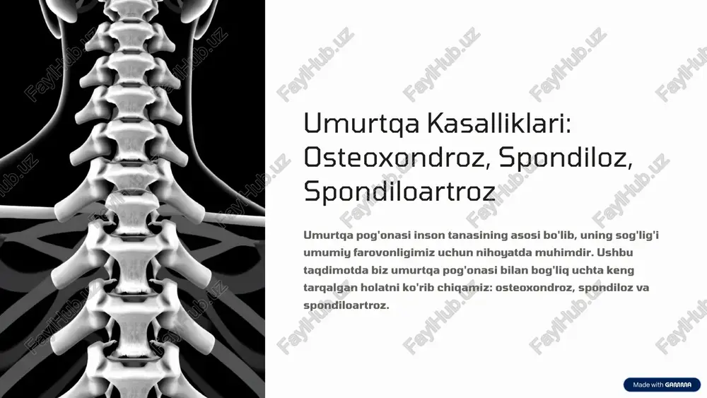 umurtqa kasalliklari: osteoxondroz, spondiloz, spondiloartroz — PPTX