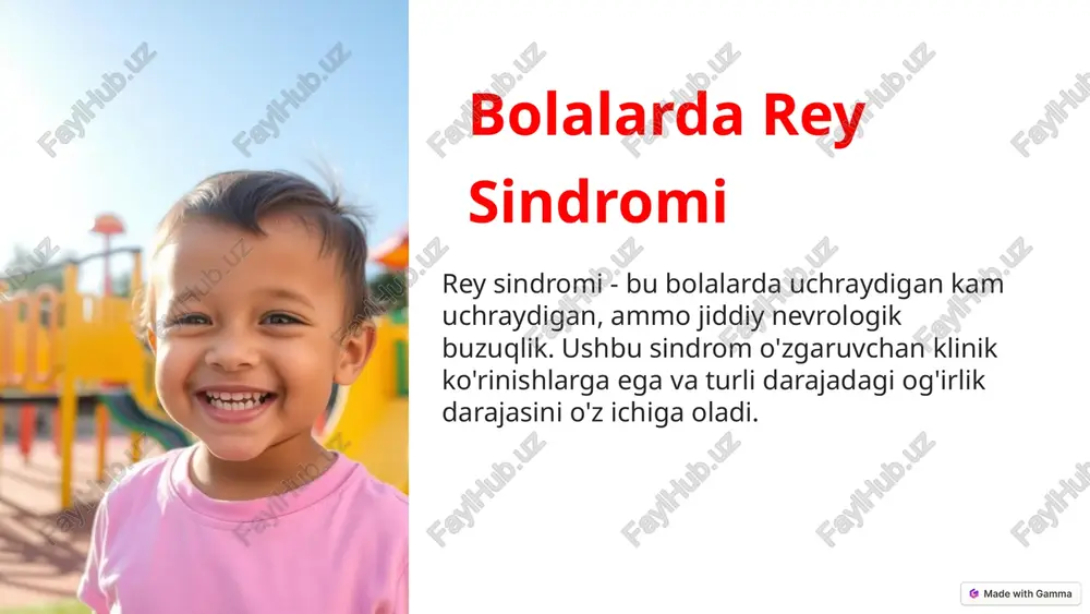 bolalarda rey sindromi — PPTX