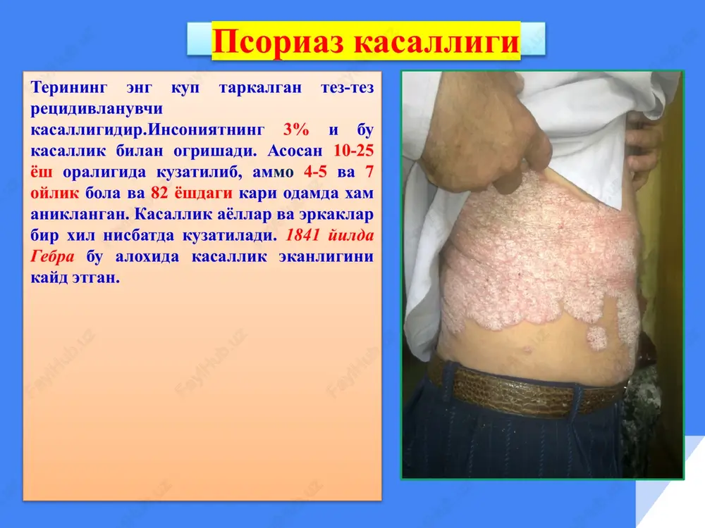 psoriaz kasalligi — PPTX