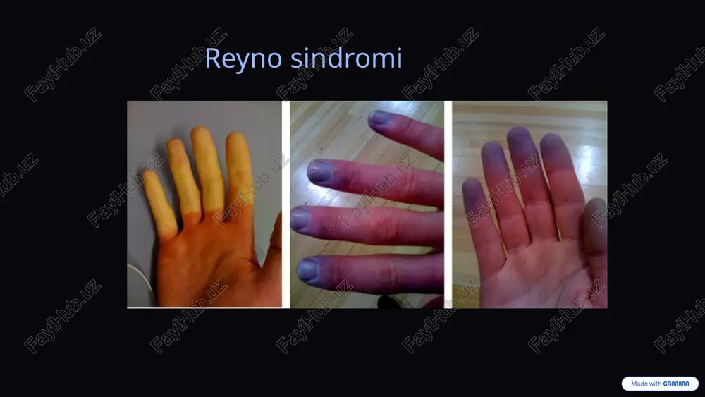 reyno sindromi — PPTX