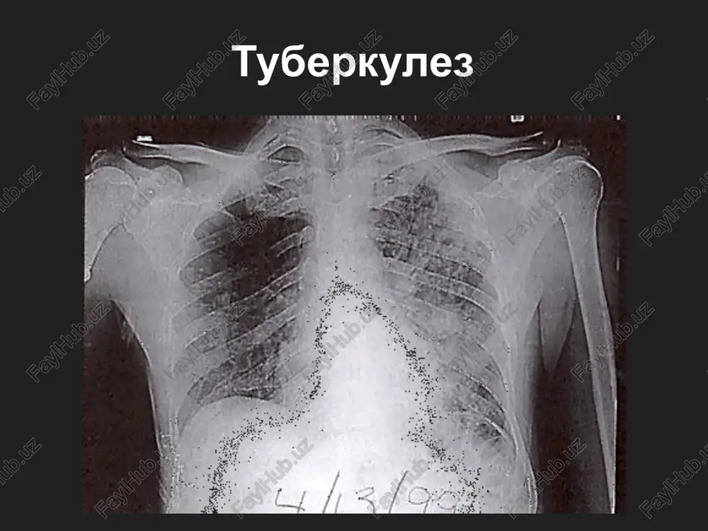 tuberkulez — PPTX