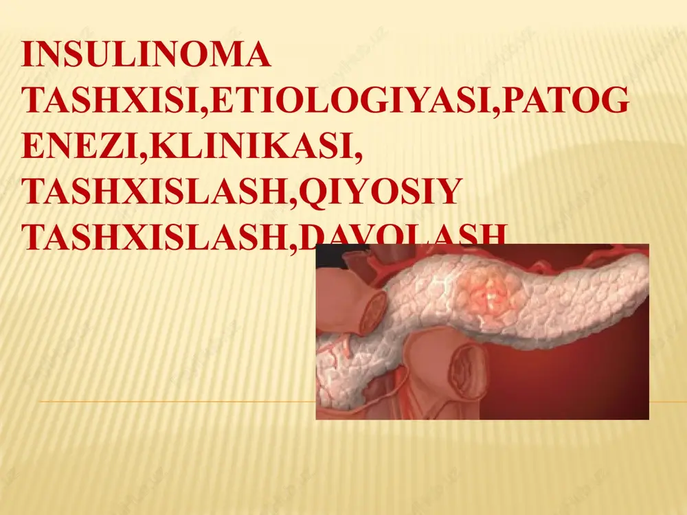 insulinoma tashxisi, etiologiyasi, patogenezi, klinikasi — PPTX