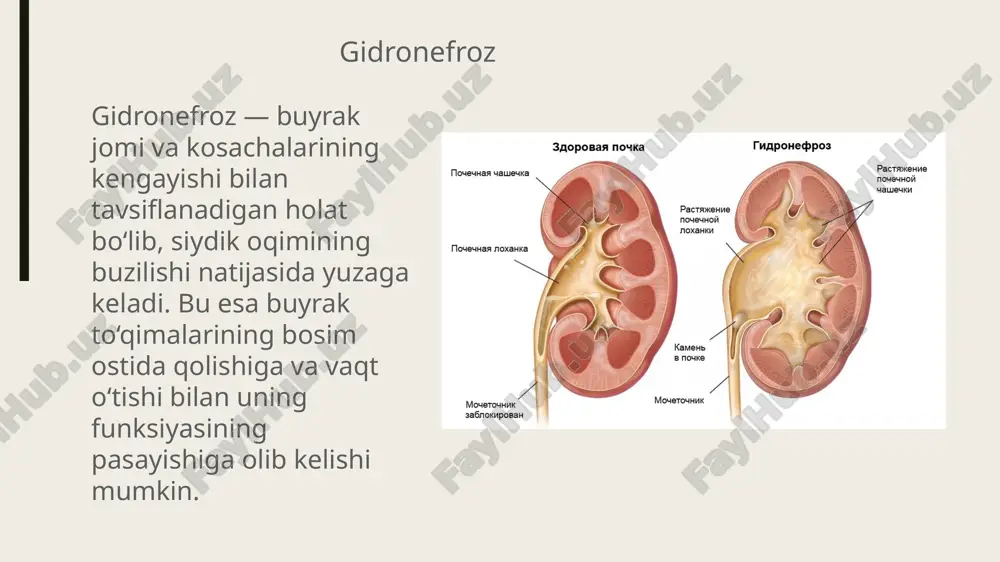 oplerosonogrfiya, endoluminal ultrasonografiya, kt, radioizotop va angiografik tadqiqotlar, uretropiyeloskopiya. instrumental diagnostika shikoyat (yonboshda og’riq, temperatura oshishi) anamnez (buyrak tosh operatsiyasi, gematuriya, temp periodik ko’tarilib turishi ko’ruv (yonboshda o’smasimon hosila, gipertermiya, gematuriya skring metod - siydik chiqaruv tizimini uzd buyrak hajmi, parenximasi, kosacha-jom tizimi diliatatsiyasi, konkrement bor yo’qligi, siydik pufagi holati, siydik pufagidagi qoldiq siydik, uretrosele prostata bezi hajmi, giperplaziyasi. ekskretor urografiya ekskretor urografiyaga qarshi ko’rsatma teri orqali nefrostomiya bilan antegrad pielouretrografiya obstruksiya darajasini bilish dinamik nefrosinsitografiya retrograd uretropielografiya obstruksiya sababini maxsus tekshiruv usullarida diagnozlash kt, mskt, mrt, uretroskopiya, nefroskopiya doplersonoografiya, endoluminal sonografiya digital subtraksion angiografiya ha yo’q davolash konservativ- faqatgina ushlab turuvchi terapiya hisoblanadi, bemorni baribir operatsiya qilish kerak antibiotik nsyq spazmolitik operativ ochiq rekonstruktiv operatsiya endourologik operatsiya-> percutan (teri orqali) va transuretral kirish mumkin laparoskopik va retroperitoneoskopik e'tiboringiz uchun rahmat image1.png image3.jpeg image4.png image5.jpeg image6.jpeg image7.jpeg image8.jpeg image9.jpeg