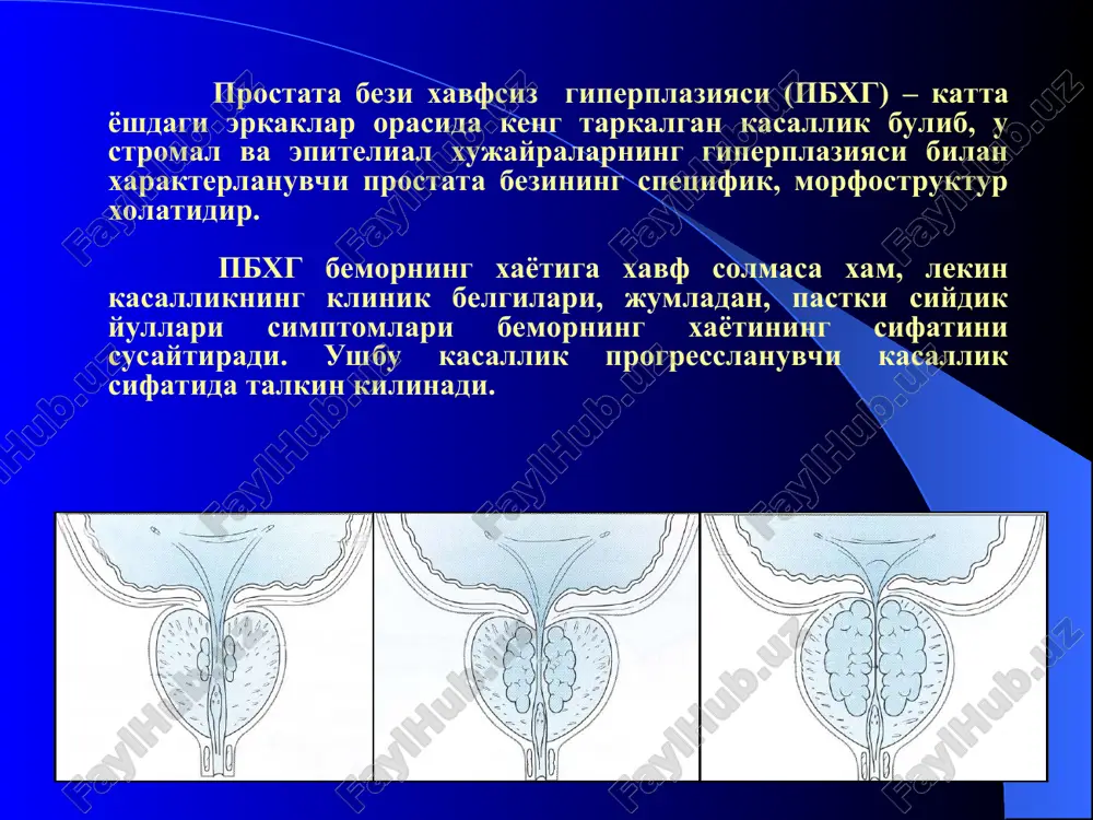 : - siyishni boshlashda kiynalish - kuchanib siyish - siydik okimining pasayishi - siyishning oxirida siydiknning tomchilab tushishi - uzok muddat davomida siyish - kovukning tulik bushamasligi xissiyoti - siydik tutilishi - siydikning noixtiyoriy chikishi pbxg simptomlari: irritativ simptomlar: - tez-tez siyish - kam mikdorda siyish - siyishda imperativlik - nikturiya - siydikni tutib tura olmaslik pbxg asoratlarining simptomlari: - gematuriya va kon ketish belgilari - kovukdagi toshning uziga xos belgilari - sbega xos bulgan belgilar - siydik yullaridagi ikkilamchi infektsiya belgilari va boshkalar. tashxislash pbxg-ni tashxislashda utkaziladigan tekshiruvlar ikki guruxdan iborat: zaruriy: bu tekshiruvlar har bir bemorda o'tkazilishi shart. fakltativ: ularni o'tkazishga ko'rsatmalar bo'lgan hollardagina bajariladi. zaruriy tekshiruvlar (birlamchi tekshirishda) kasallik tarixi. ipss va bs suroknomalari. kon zardobidagi prostatospetsifik antigen (psa) mikdorini aniklash. kon zardobidagi kreatinin mikdorini aniklash. fizikal kurish va prostata bezini tugri ichak orkali barmok bilan tekshirish. siyish kundaligi. siydik taxlili. (pbxg buyicha 5-chi xalkaro kengash ma'lumotlariga …