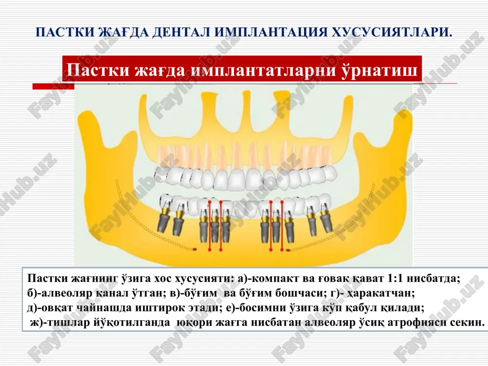 lishi: - implant materialiga ; - implant shakliga ; - tish protezlariga tushadigan bosimga ; implantat tanasida teshiklar, yoriqlar bo'lishiga; implantat yuzasiga titan yoki gidrooksiappatit bilan changlatishga; implantat bo'yin qismini silliqlanishiga (polirovka); og'iz bo'shlig'ini gigienasiga; - umumiy organizm xolatiga bog'liq. bemorlarni tekshirish usullari qonni umumiy tahlili qondagi qand miqdorini aniqlash koagulogramma siydik umuiy tahlili ortopantomogramma dental rentgen yusupov buyicha rentgen rentgen kompyuter tomografiya magnit-rezonans tomografiya laborator tekshirish nur diagnostikasi stomatologik anamnez yuz-jag' soxasi tashqi ko'rigi og'iz bo'shlig'ini ko'zdan kechirish jag'larni diagnostik modellarini o'rganish. klinik tekshiruvlar alveolyar usikni xolatini urganish. shillik kavat va alveolyar usik kalinligini ulchash asboblari shilliq osti suyak pardasi osti dental implantatsiga ko'rsatma va qarshi qo'rsatmalar dental implantatsiga ko'rsatmalar bitta old (frontal) yoki chaynov tishlar bo'lmaganda. tish qatorini chegaralangan nuqsonlarida (3ta va undan ortiq tishlarni yo'qligi) tish qatorini chegaralanmagan nuqsonlari. tishlarni umuman yo'qligi. bemorlarda akrilatlarga yuqori sezuvchanlik va qayt qilish refleksi rivojlanganligi sababli olinadigan protezlardan foydalana olmaslik. funktsional …