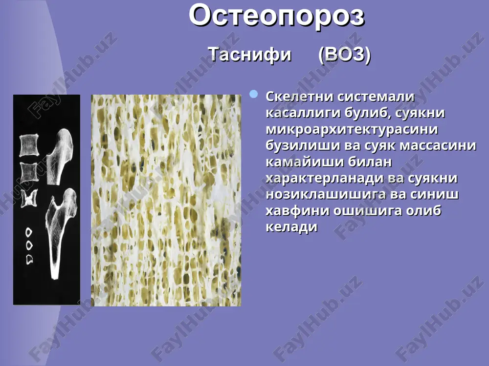 m suyak osteoporozni suyak tukimasiga ta'siri suyak tukimasini massasini sezilarli kamayishi suyak tukimasi uzining «kurilishi» bilan normal kurinadi, lekin matriks strukturasi va mineralizatsiyasi buziladi, shuning okibatida suyak deyarli kattiklashib koladi. suyak tukimasi trabekulyar arxitekturasini buzilishi (gubkasimon) , trabekul torayishi va yukolishi bilan mosekilde l. knoglevævets biologi. isbn 87-983055-1-4, 1989 * zabolevanie xarakterizuetsya stol silnim umensheniem kostnoy massi, chto ee kolichestvo stanovitsya nedostatochnim dlya podderjaniya tselostnosti skeleta. kostnaya tkan po svoemu «postroeniyu» viglyadit normalnoy, no struktura matriksa i mineralizatsiya narushayutsya, vsledstvie chego kost stanovitsya menee plotnoy osteoporoz bilan jaroxatlangan suyak ushbu uzgarishlar okibatida suyaklar nozik bulib koladi va oson sinadi. aksariyat sinish uchastkalari – umurtkalar, kaft suyaklari va son suyagi buyinchasi tasoddifiy sinishlarni chastotasini tekshirish (asosan kul-oyoklar sinishida) osteoporozni axoli orasida tarkalishini baxolash metodlaridan biri bulishi mumkin osteoporotik sinishlar - opni eng ogir asoratlaridan biridir * umurtkani osteoporotik sinishi * osteoporoz suyaklar sinishi sabab nogironlik va ulim kuzatilishi darajasi buyicha, noinfektsion …