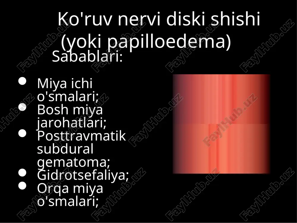 ilganda ikki tomonlama midriaz; ko'ruv yo'qolgan sohalarga ko'ra gemianopsiya klassifikatsiyasi; to'liq qisman kvadrant gemianopik skotoma ko'ruv yo'lining periferik qismi 1- ko'ruv nervi 2- xiazma 3- ko'ruv trakti chap tomonlama (a) va o'ng tomonlama (b) gomonim gemianopsiya. bu tashqi genikulyar tana sohasida ko'ruv nervi shikastkanganda kuzatiladi. yuqori va pastki kvadrant gomonim gemianopsiyasi. bu ko'ruv analizatori po'stloq sohasidan zararlanganda kuzatiladi. ko'ruv kesishmasining ichki sohalari shikastlanishida bitemporal geteronim gemianopsiya bo'ladi. ko'ruv kesishmasining tashqi qismlari shikastlanganda binazal geteronim gemianopsiya kuzatiladi. e'tiboringiz uchun rahmat!!!