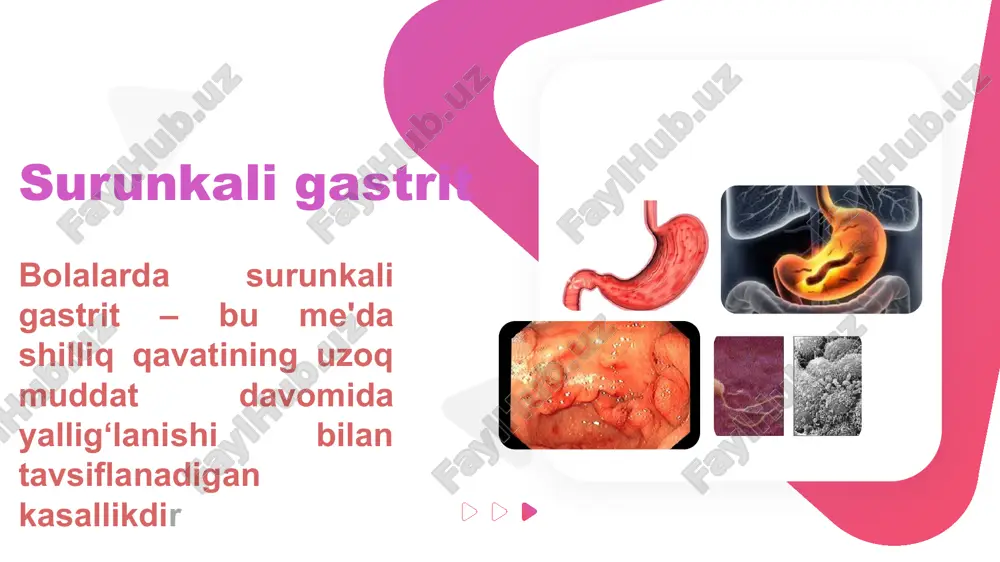 rda uchraydi, asosan 5-14 yosh oralig'ida. etiologiyasi infeksion omillar: helicobacter pylori infeksiyasi oziqlanish: noto'g'ri va balanssiz ovqatlanish, qattiq va o'tkir taomlar iste'moli dori-darmonlar: antibiotiklar, nsar (non-steroid yallig'lanishga qarshi dorilar) genetik moyillik: ota-onalarda oshqozon yoki ichak kasalliklari patogenezi oshqozon va o'n ikki barmoq ichakning shilliq pardasida yallig'lanish jarayoni yuzaga keladi. h. pylori infektsiyasi kislotali muhitda ko'payib, shilliq pardaga zarar yetkazadi. oshqozon kislotaliligining oshishi va shilliq pardaning himoya xususiyatlarining susayishi yallig'lanishning davom etishiga olib keladi. klinikasi qorin og'rig'i (epigastriyadagi og'riq, ayniqsa ovqatdan so'ng) ko'ngil aynishi, qusish ishtahaning yo'qolishi diareya yoki konstipatsiya charchoq, og'irlik sezishi ba'zan aritmiya yoki achishish diagnostikasi laboratoriya tekshiruvlar: h. pylori aniqlash (breath test, serologiya, pcr) qon tahlili (anemiya, ) endoskopiya (gastroskopiya): shilliq parda eroziyasi yoki yallig'lanishi biopsiya: o'zgarishlarni aniq tasdiqlash uchun surunkali gastroduodenitni davolash 1. etiologik davolash h. pylori infektsiyasi: antibiotiklar (amoksitsillin, klaritromitsin). ppi (omeprazol, lansoprazol). 2. simptomatik davolash antatsidlar: almagel, maalox. sekretor boshqaruv: ranitidin, famotidin. shilliq qavatni tiklash: …