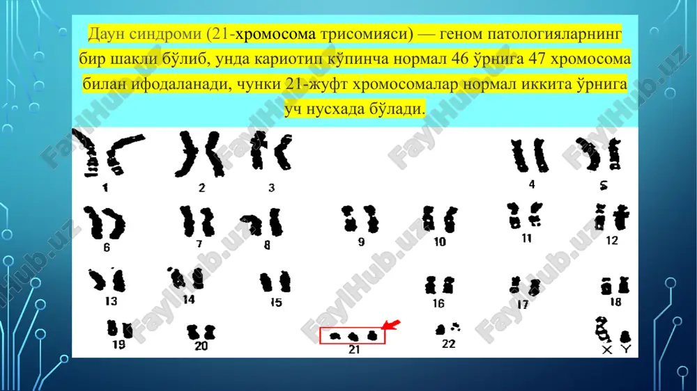 ndromining kuzatilishi bevosita ona yoshiga bog'liq. keyinchalik ma'lum bo'ldiki, daun sindromi 21-juftlik xromosomasining me'yoriy miqdorida, ya'ni ikkita bo'lganida ham yuzaga kelishi mumkin. biroq bunda xromosomalardan birining qismi ikkilanishi yuz beradi, natijada xromosomaning noma'lum genlarning noaniq miqdori bo'lgan anomal parcha paydo bo'ladi.inson genomi tadqiqi bo'yicha ishlar yakunlanganidan keyingina manzara asta-sekin oydinlashib bordi. daun sindromining 10 ta asosiy tashqi belgilari shulardan 4-5 tasining mavjudligi daun sindromining mavjudligiga ishora qiladi: • yuz profilining zichlashuvi (90%); • so'rish refleksining yo'qligi (85%); • mushak gipotoniyasi (80%); • ko'zlarning mongoloidlarga xos qisiqligi (80%); • bo'yindagi ortiqcha teri (80%); • bo'g'inlarning bo'shashganligi (80%); • displastik tos (70%); • displastik (deformatsiyalangan) quloq chanoqlari (60%); • jimjiloq klinodaktiliyasi (60%); • kaftning to'r barmoqli bukilish burmasi (ko'ndalang chiziq) (45%). daun sindromiga xos qirralarga ega bo'lgan bolalar braxitsefaliya, yumaloq yuz, makroglossiya va ochiq og'iz, epikant, gipertelorizm, enli qanshar, «zog'ora baliqnikiga o'xshash og'iz», g'ilaylik bosh suyagi va yuz tuzilishidagi buzilishlar "yassi, yapaloq …