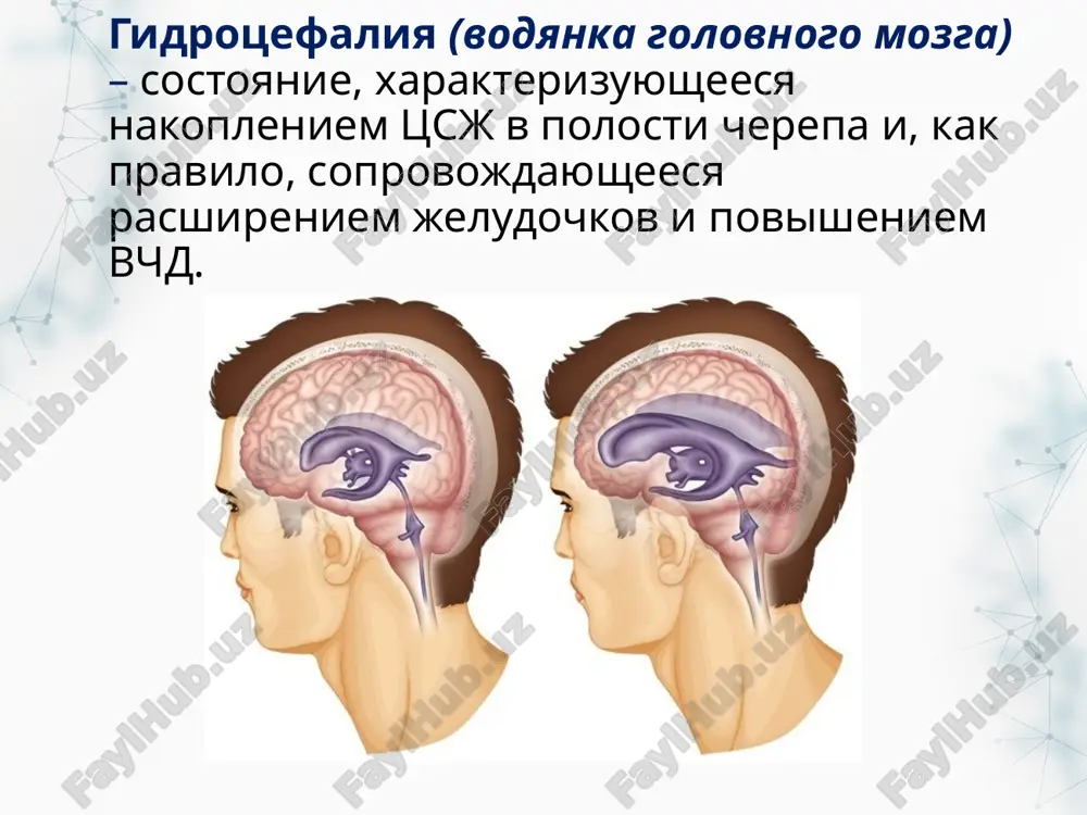 ie snijenie intellekta narushenie xodbi parkinsonizm tazovie rasstroystva sindrom parino (paralich vzora vverx + konvergiruyushiy nistagm + retraktsiya vek + paralich akkomodatsii + utrata reaktsii na svet) normotenzivnaya gidrotsefaliya variant soobshayusheysya (neobstruktivnoy) gidrotsefalii, svyazanniy s narusheniem vsasivaniya tssj na konvekstialnoy poverxnosti golovnogo mozga. rasshirenie jeludochkov proisxodit pri otsutstvii klinicheskix priznakov vnutricherepnoy gipertenzii, a davlenie tssj pri lp okazivaetsya normalnim ili neznachitelno povishennim prichini: fibroz i srashenie mozgovix obolochek dekompensatsiya vrojdennoy gidrotsefalii v pojilom vozraste klinicheskie proyavleniya (triada xakima-adamsa) narusheniya xodbi – «apraksiya» xodbi, lobnaya disbaziya 1 dementsiya 2 narusheniya mocheispuskaniya 3 3 nb! normalnaya poxodka u bolnogo s dementsiey isklyuchaet normotenzivnuyu gidrotsefaliyu; mrt priznaki tserebralnoy atrofii (a) pri bolezni altsgeymera i (v) normotenzivnoy gidrotsefalii na snimke sprava otmechaetsya okruglaya forma rogov bokovix jeludochkov, sglajennost borozd bolshix polushariy. test fishera ili «tap-test» odnokratnoe vivedenie 20–50 ml likvora pri lyumbalnom prokole ili vivedenie po 30 ml v techenie 3 dney fiksiruetsya: - …