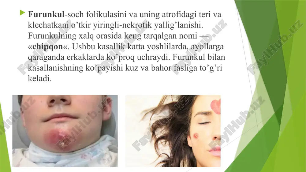 iga u sezilarli qizil-ko’k rangda bo’ladi, so’ng asta-sekin rangsizlanib, deyarli ko’rinmas holga keladi. tashxis: umumiy qon va siydik tahlillari; qonda qand miqdorini aniqlash uchun tahlil; siydikni bakteriologik ekish; faringo- va rinoskopiya; burun yon sinuslarning rentgenografiyasi; flyuorografiya; qorin bo’shlig’i a’zolari va buyraklarning ultratovush tekshiruvi. zarur bo’lganda, bemorga qo’shimcha ravishda endokrinolog, gastroenterolog, pulmonolog, otorinolaringolog va boshqa mutaxassislar maslahat beradi. differensial diagnostikasi davolash: furunkul yetilishi bosqichida unga ixtiolli bog’lamlar qo’yiladi, quruq issiq, uych-terapiya qo’llaniladi. u ochilganidan so’ng, gipertonik natriy xlorid eritmasi, metiluratsil bilan kombinatsiyalangan xloramfenikol saqlagan malham bilan turunda qo’llaniladi. nekrotik o’zakning chiqishi qiyin bo’lsa, proteolitik fermentlar ko’rsatiladi: tripsin, ximotripsin. tuzalish bosqichida davolanish antibakterial va shifobaxsh vositalar bilan amalga oshiriladi davolash yallig'lanish sohasi 70 0+2% salitsil spirt bilan artilib nacl gipertonik eritmasi bilan bog'lam qo'yiladi va tomchilab doimiy ho'llab turiladi. teriga tashqaridan har qanday ta’sir etish, teginish taqiqlanadi (ayniqsa-soqol olish, timdalash, siqish}. yiringli jarayon atrofidagi to'qimalarga anestetiklar novokain, lidokain, trimekain (eritilgan antibiotikli) bilan …