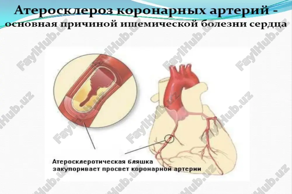 t kak v trombotsitax, tak i v sosudisty stenke. tromboksan a2 (kotoriy sinteziruetsya v trombotsitax) obespechivaet agregatsiyu trombotsitov krovi i obrazovanie trombov. ask podavlyaet etot protsess, chto yavlyaetsya vo vsex otnosheniyax jelatelnim effektom pri ee naznachenii po sosudistim pokazaniyam. ask privodit bezyadernie trombotsiti k potere ix sposobnosti agregirovatsya na protyajenii vsey prodoljitelnosti ix jizni, kotoraya sostavlyaet 7-10 dney. etot polezniy prodoljitelniy effekt ne svoystvenen drugim antiagregantnim preparatam. ejednevno obnovlyaetsya okolo 10% vsego pula trombotsitov, i posle odnokratnogo vvedeniya ask neobxodimo minimum 5 dney dlya togo, chtobi xotya bi polovina trombotsitov vosstanovila svoyu normalnuyu funktsiyu. u patsientov s sosudistimi zabolevaniyami etot protsess mojet uskoryatsya. uchenie polagayut, chto uroven aktivnix trombotsitov, ravniy primerno 20%, vpolne dostatochen dlya podderjaniya normalnogo gemostaza. prostatsiklin, obrazuemiy endotelialnimi kletkami, s sposoben podavlyat agregatsiyu trombotsitov i okazivat vazodilyatiruyushiy effekt. takim obrazom, podavlenie ask sinteza etogo mediatora yavlyaetsya nejelatelnim. analogichno deystviyu v trombotsitax, ask neobratimo ingibiruet aktivnost tsiklooksigenazi v …