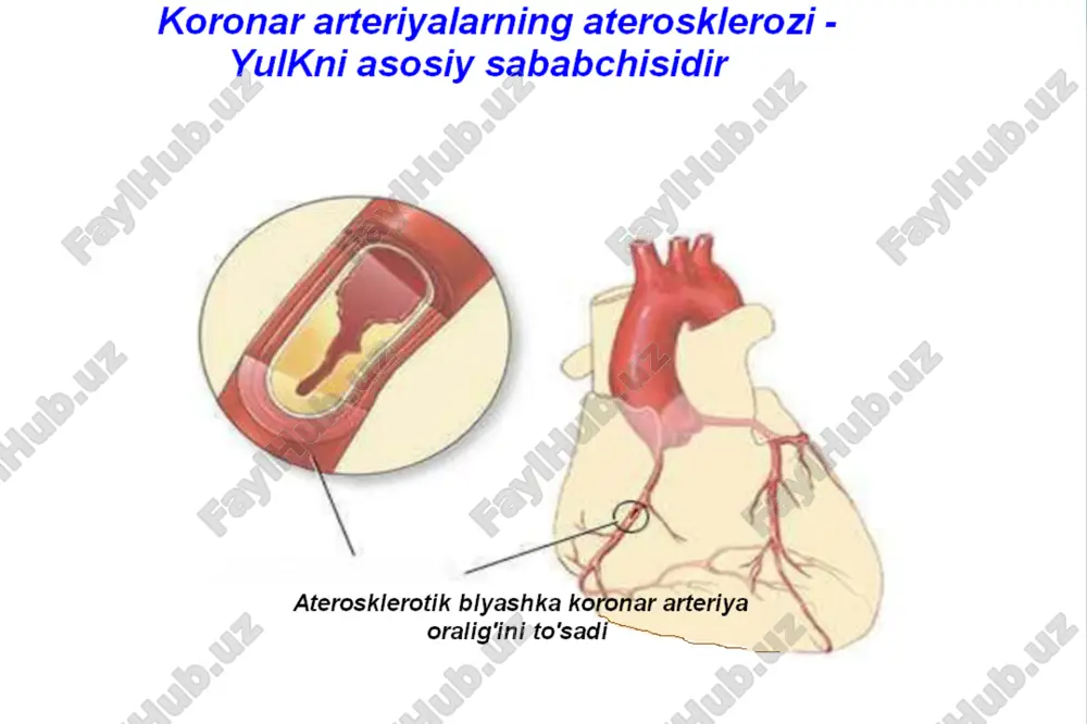 tromboksan a2 (kotoriy sinteziruetsya v trombotsitax) obespechivaet agregatsiyu trombotsitov krovi i obrazovanie trombov. ask podavlyaet etot protsess, chto yavlyaetsya vo vsex otnosheniyax jelatelnim effektom pri ee naznachenii po sosudistim pokazaniyam. ask privodit bezyadernie trombotsiti k potere ix sposobnosti agregirovatsya na protyajenii vsey prodoljitelnosti ix jizni, kotoraya sostavlyaet 7-10 dney. etot polezniy prodoljitelniy effekt ne svoystvenen drugim antiagregantnim preparatam. ejednevno obnovlyaetsya okolo 10% vsego pula trombotsitov, i posle odnokratnogo vvedeniya ask neobxodimo minimum 5 dney dlya togo, chtobi xotya bi polovina trombotsitov vosstanovila svoyu normalnuyu funktsiyu. u patsientov s sosudistimi zabolevaniyami etot protsess mojet uskoryatsya. uchenie polagayut, chto uroven aktivnix trombotsitov, ravniy primerno 20%, vpolne dostatochen dlya podderjaniya normalnogo gemostaza. prostatsiklin, obrazuemiy endotelialnimi kletkami, s sposoben podavlyat agregatsiyu trombotsitov i okazivat vazodilyatiruyushiy effekt. takim obrazom, podavlenie ask sinteza etogo mediatora yavlyaetsya nejelatelnim. analogichno deystviyu v trombotsitax, ask neobratimo ingibiruet aktivnost tsiklooksigenazi v endotelialnix kletkax, no v dannom sluchae v endotelii postoyanno …