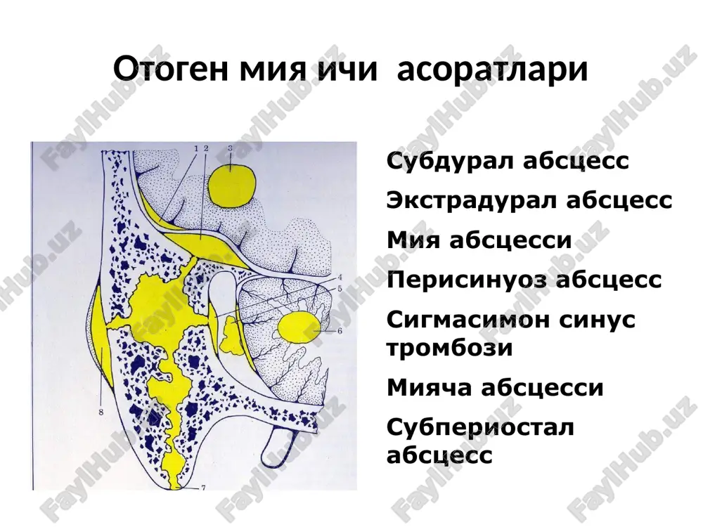 legavoy sobaki) yotishi; davolash urta kulokdagi yiringli protsessni eliminatsiya kilishga karatilgan operativ davo(utkir otit – antromastoidotomiya, surunkali otit – kengaytirilgan radikal bushlik operatsiyasi); davolash antibiotikoterapiya – gematoentsefalik barerdan utuvchi, keng doirada ta'sir kiluvchi antibiotiklar, (tsefalosporinlar, metronidazol, penitsilin va b.). shuningdek antibiotiklar orka miya kanaliga xam yuboriladi davolash dezintoksikatsion terapiya (reopoliglyukin, nativ plazma va b.); degidratatsion terapiya (laziks, 40% glyukoza va b.); antigistamin preparatlar (dimedrol, suprastin va b.); glyukokortikosteroidlar parenteral; simptomatik terapiya. miyacha abstsessining umumiy belgilari miyacha abstsessi uchun kuyidagi belgilar xos: a) bosh aylanishi b) nistagm v) koordinatsiya buzilishi g) skelet muskulaturasi funktsiyasi buzilishi miyacha abstsessi klinikasi 1). asta sekin miya ichi xajmli xodisa belgilarini paydo bo'lishi bilan jarayonining kechishi. a. ensa soxasida kunning ikkinchi yarmi va kechkurun dominantlik kiluvchi, rivojlanib boruvchi, yakkol ba'zida chidab bo'lmaydigan bosh og'rig'i. b. ko'ngil aynashi, kuchli bosh og'rig'i paytida qusish. v. bradikardiya (45 ta minutgacha). g. arterial kon bosimining oshishi, medikamentoz davolash natijasizligi. boshning …