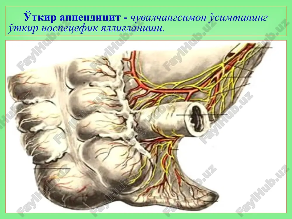 ishi chuvalchangsimon o'simtani kirish teshigini yopilishi o'tkir appenditsit xastaligini v.i. kolesov bo'yicha klassifikatsiyasi (tasnifi) appendikulyar sanchiq (kolika). oddiy appenditsit. destruktiv appenditsit: flegmonoz, gangrenoz, perforativ appenditsit. asoratlangan appenditsit: appendikulyar in-filtrat, appendikulyar abstsess, peritonit, pile-flebit va boshqalar. chuvalchangsimon o'simtaning odatdagi ko'rinishi o'tkir oddiy appenditsit o'tkir appenditsitning destruktiv turlari chuvalchangsimon o'simta empiemasi gangrenoz perforativ appenditsit shikoyatlari ko'p uchraydigan 1 – o'ng yonbosh sohadagi og'riq 1. og'riq epigastral sohadan boshlanib keyinchalik o'ng yonbosh sohaga ko'chadi (koxer-volkovich simptomi) 2. doimiy (kamdan-kam to'lg'oqsimon), 3. kuchsiz (ezuvchi) 4. hech qaerga tarqamaydi 2 – ko'ngil aynish, qayt qilish (1 yoki 2 marotaba) 3 – kam quvvatlik, ishtahaning susayishi tenezmlar – chanoq sohasida joylash-ganda, ich ketish – medial joylashganda, dizuriya – retrotsekal joylashganda, og'iz qurishi, qorinning dam bo'lishi va ich kelmasligi – peritonitda. chuvalchangsimon o'simtani joylashi va jarayonning darajasiga bog'liq bo'lgan shikoyatlar: o'tkir appenditsitning mahalliy belgilari voskresenskiy («ko'ylak») – ko'ylak ustidan sirpanuvchi harakat qilganda o'ng yonbosh sohada og'riqni kuchayishi …