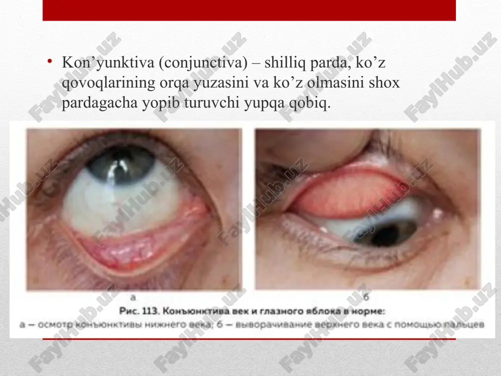 r kattalashishi(konyuktiva qopollashishi) parda paydo bulishi konyuktival inyeksiya (giperimiya) konyuktivitlarning asosiy shikoyatlari va kilinik belgilari; yoruglikdan qurqish kuz yoshlanishi kuzda qum xissi ogriq shilliq/yiringli ajralma kuzlarning qizarishi(konyuktival/aralash inyeksiya) gonokokkli kon’yunktivit (gonoblennoreya) – shox parda shikastlanishi ehtimolida kelib chiquvchi o’ta og’ir va xavfli kon’yunktivit. klinik jihatdan chaqaloqlar, bolalar va kattalar gonoblennoreyasi farqlanadi. chaqaloqlar gonoblennoreyasi. odatda, patologik jarayon bir tomonlama, bola tug’ilgandan keyin 2-3-kunda (inkubatsiya davri) kasallikning birinchi alomatlari namoyon bo’ladi. klinikasi: tez kuchayib boruvchi zich shish bilan qovoqlarning qizarishi. ko’rik uchun qovoqlarni ochishga urinishda ko’z tirqishidan bosim natijasida gemorragik tusli seroz suyuqlik oqadi. qovoqlar kon’yunktivasi giperemiyalangan, infiltrlangan, yumshagan va oson qon ketadi. 3-5 kundan so’ng jarayon to’satdan o’zgaradi: qovoqlar yumshaydi, ularning shishi kamayadi, ko’zlardan ko’p miqdorda quyuq sariq-yashil yiring oqadi asorati gonoblennoreyaning xavfi, jarayonga shox parda qo’shilganida kelib chiqadi. qovoqlar va kon’yunktiva shishi uning oziqlanishini buzadi, epiteliy shilinadi, shox parda xiralashib qoladi. buning fonida tez orada yiringli yaraga aylanadigan sariq-kulrang infiltrat …