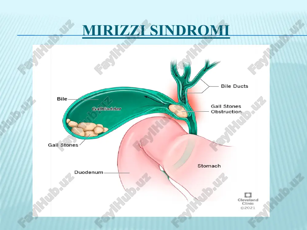 ilar, bunda cystic kanali uzun bo'lib, gepatikokoledoxning pastki uchdan bir qismiga oqib tushadi. bunday holda, agar cystic kanalida tosh bo'lsa, jigarning umumiy kanalini siqish va patologik sindromning rivojlanishi xavfi ortadi. mirizzi sindromining patogenezi: 1) umumiy o't yo'lining tashqi tomondan siqish, ko'pincha o'tkir kalkulyoz xoletsistit fonida paydo bo'ladi; 2) jigardan tashqari o't yo'lining strikturasi; 3) gepatikoxoledoxning striktura mavjudligida teshilishi; 4) bilan vezikoxoledoxeal oqma hosil bo'lishi strikturani bir vaqtning o'zida bolishi klinik kechishi mirizzi sindromi asosan obstruktiv sariqlikning rivojlanishi bilan o'tkir va surunkali xoletsistit belgilari bilan tavsiflanadi. bemorning tarixi obstruktiv sariqlik davrlari bilan kesishgan tez-tez xurujlar bilan uzoq davom etadigan xolelitiyozni ko'rsatadi. mirizzi sindromining uchta asosiy belgilari mavjud: qorinning yuqori o'ng kvadrantida og'riq; sariqlik; xolangit belgilari (sariqlik, titroq, isitma) diagnostika ultratovush tekshiruvi (diagnostik qiymati 8-67%) mrt (mr xolangiografiya) (diagnostik qiymati 94,4%); endoskopik retrograd xolangiopankreatografiya; antegrad teri va jigar orqali xolangiografiya. ultratovush tekshiruvi endoskopik retrograd xolangiopankreatografiya mrpxg kt davolash: mirizzi sindromini davolashning asosiy …