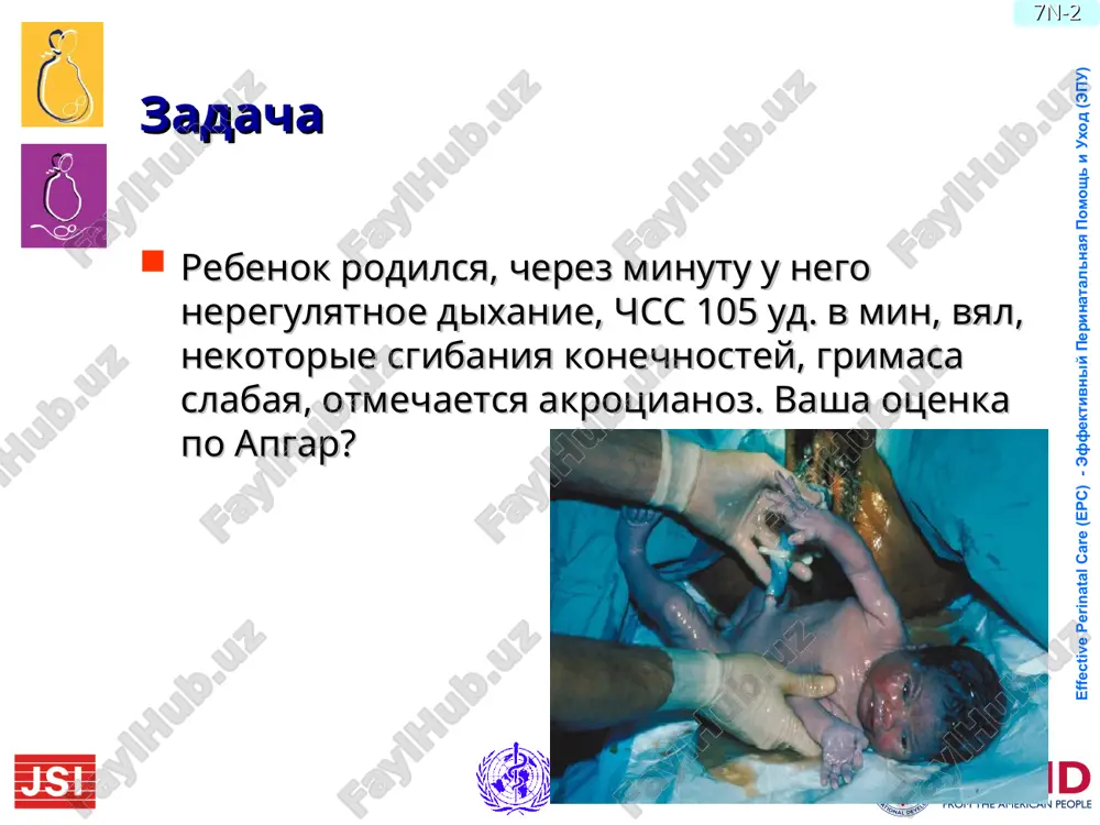 terialnoy krovi ploda gipoksiya -nedostatok vnutrikletochnogo kisloroda dlya osushestvleniya aerobnogo metabolizma i virabotki neobxodimogo ob'ema energii asfiksiya: -polniy perexod na anaerobniy put metabolizma -nedostatok virabotki energii, neobxodimoy dlya podderjaniya funktsionalnoy aktivnosti kletok -narushenie funktsii organov i sistem ploda 7n-* effective perinatal care (epc) - effektivniy perinatalnaya pomosh i uxod (epu) 7n-* gipoksemiya dlya osushestvleniya optimalnogo mexanizma virabotki energii v kletkax tkaney ploda neobxodimo postoyannoe postuplenie v nix kisloroda pri neoslojnennoy beremennosti vo vremya neprodoljitelnogo ponijeniya kontsentratsii kisloroda v krovi ploda razvivayutsya adaptivnie reaktsii plodovoplatsentarnoy gemodinamiki energeticheskiy balans sistemi mojet podderjivatsya v techenii nedel i mesyatsev k kontsu beremennosti –predel rezervnix vozmojnostey adaptatsii k gipoksemicheskim sostoyaniyam pri dlitelnom techenii gipoksemii vozmojnosti adaptatsii bistro istoshayutsya effective perinatal care (epc) - effektivniy perinatalnaya pomosh i uxod (epu) 7n-* effective perinatal care (epc) - effektivniy perinatalnaya pomosh i uxod (epu) 7n-* gipoksiya esli kontsentratsiya kisloroda v krovi dlitelnoe vremya ostaetsya snijennoy- gipoksiya nedostatok kisloroda …