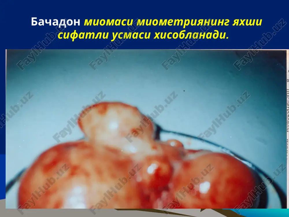 in, bunga qarama-qarshi o’laroq, mayda shilliq osti mioma tugunchalari ko’p qon ketishiga, menorragik va hatto menometrorragik hayz sikli buzilishiga olib keladi.hayz 10-12 kungacha davom etib, juda ko’p miqdorda qon ketadi, bunga giperpolimenoreya deyiladi. bunday turdagi qon ketishining sabablari: 1.bachadon mushaklari qisqarishining buzilishi 2. bachadon shilliq qavati yuzasining kattalashishi 3. estrogen gormon metabolizmining o’zgarishi 4. bachadon shilliq qavati regenerasiyasining susayishidan iborat miomalarda og’riq bo’lishining asosiy sabablari: 1.og’riq asosan o’smaning katta- kichikligiga va uning qayerda joylashganligiga bog’liq 2. bachadon shilliq qavati ostiga joylashgan o’smalarda hayz ko’rish vaqtida yig’ilgan qonni hamda shu bilan birga shilliq qavat ostidagi o’smani ham bachadondan tashqariga chiqarish kuchli dardsimon og’riq paydo qiladi. 3. og’riq paydo bo’lishining yana bir sababi o’smaning infeksiyalanishi bo’lsa, ikkinchidan, bachadonning yallig’lanishi hisoblanadi. kichik chanoq bo’shlig’idagi a’zolarning yallig’lanishi bachadon miomasi birga uchraganda 2/3 hollarda bemorlarda og’riq paydo bo’ladi 4. og’riq subseroz o’sma oyoqchasi buralib qolgan vaqtlarda ham sodir bo’ladi. chunki bunda o’sma oyoqchasi tarkibidagi qon …