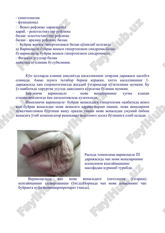 ashi kuzatiladi. klassifikatsiyasi hozirgi kunda urug' tizimchasi venalarining varikoz kengayishining bir nechta klassifikatsiyalari mavjud. darajasiga qarab - birinchi daraja (paypaslaganda valsalva sinamasi musbat, varikoz kengaygan venalar paypaslanmaydi). - ikkinchi daraja (urug' tizimchasini paypaslaganda varikoz kengaygan venalar aniqlanadi). - uchinchi daraja ( varikoz kengaygan venalar viziul ko'rganda aniqlanadi) zararlanish tomoniga qarab - chap tomonlama - o'ng tomonlama - ikki tomonlama etiologiyasiga qarab - birlamchi - simptomatik - funktsional venoz reflyuks xarakteriga qarab. - renotestikulyar reflyuks bilan -ileotestikulyar reflyuks bilan - aralash reflyuks bilan. buyrak venasi gipertenziyasi bilan qo'shilib kelganda. a) varikotsele buyrak venasi gipertenzion sindromi bilan. b) varikotsele buyrak venasi gipertenzion sindromisiz. - fizikal usullar bilan aniqlash a) klinik b) subklinik. ko'p hollarda klinik amaliѐtda kasallikning og'irlik darajasi hisobga olinadi. ammo shunga e'tibor berish kerakki, xatto kasallikning 1- darajasida ham spermatogenezda jiddiy o'zgarishlar ko'zatilishi mumkin. bu o'z navbatida xirurgik usulda davolashga qo'rsatma bo'lishi mumkin. birlamchi varikotsele – moyak venalarining tug'ma klapan …