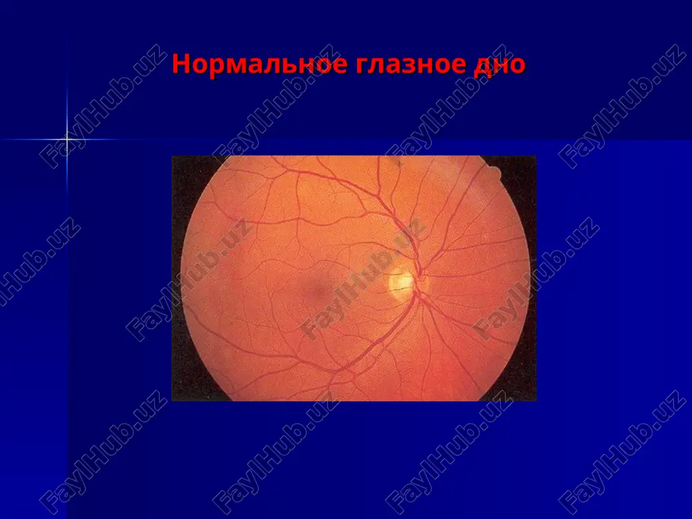 ta arteriy uvelichivaetsya izvitost arteriy i ven simptom «mednoy provoloki» (v svyazi s gialinozom stenok arteriy poyavlyaetsya refleks po xodu sosudov) simptom «serebryanoy provoloki» (za schet rezkogo sujeniya prosveta sosudov) simptom arteriovenoznogo perekresta ii-iii stepeni (simptom salyusa-gunna) serdechno-sosudistaya patologiya gipertonicheskaya bolezn tretya stadiya: gipertonicheskaya angioretinopatiya i neyroretinopatiya voznikayut iz-za povisheniya pronitsaemosti sosudov. krovoizliyaniya v setchatku, eyo otyok «tverdie» ekssudati (jeltovatie, chetko ocherchennie, blestyashie) «myagkie» ekssudati (v vide komochkov vati), za schet lokalnix infarktov v zone zakuporki kapillyarov formirovanie v zadnem polyuse glaza figuri «zvezdi» (ekssudati ukladivayutsya v sootvetstvii s raspolojeniem nervnix volokon setchatki) otek zritelnogo nerva (pri tyajelom techenii gipertonii) serdechno-sosudistaya patologiya gipertonicheskaya bolezn serdechno-sosudistaya patologiya gipertonicheskaya bolezn a b v a) simptom mednoy i serebryannoy provoloki pri arterialnoy gipertenzii b) zlokachestvennaya gipertenziya. figura mnogoluchevoy zvezdi v makulyarnoy oblasti v) zlokachestvennaya gipertenziya. zastoyniy disk zritelnogo nerva. preretinalnie i retinalnie krovoizliyaniya. ostraya neproxodimost tsentralnoy arterii setchatki (tsas) i ee vetvey mojet …