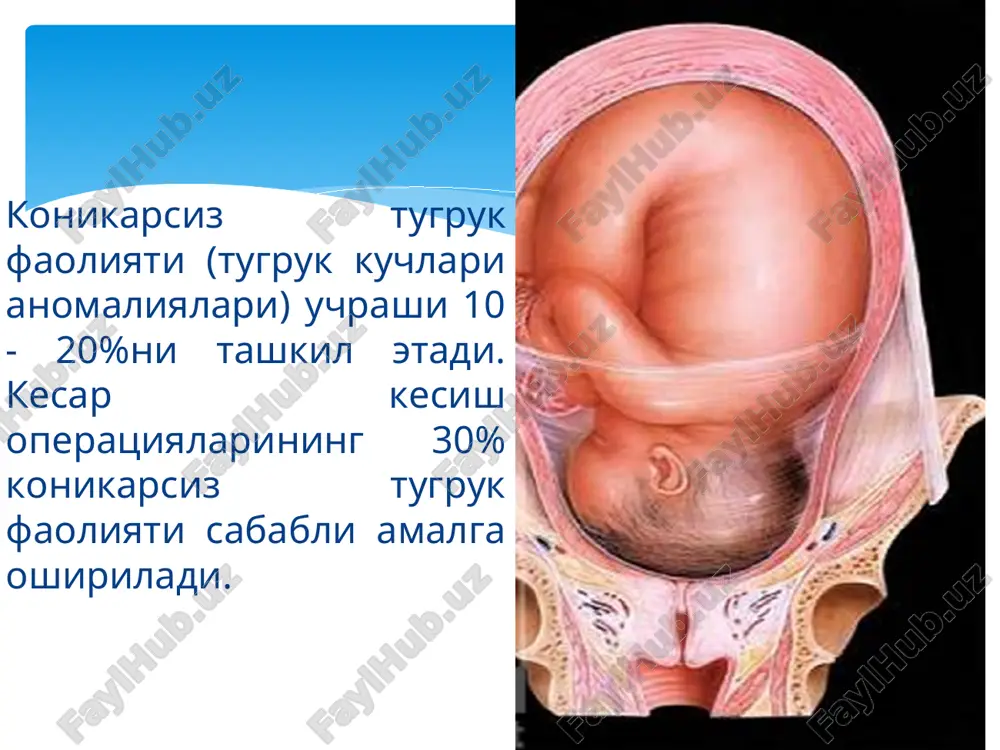 don buyni ochilishi tug'ruq komponentlariga kiradi tulg'oqlar (dard) va kuchaniqlar kiradi.tulg'oqlar dard tutishi– bu bachadonni davriy ravishda ixtiyorsiz qisqarishlari bo'lsa kuchaniqlar - bu qorin pressining ixtiyoriy qisqarishlari. tugrukni birinchi davri tugrukni 1-yarmida bachadonni kiskarishi bachadon buynining ochilishiga olib keladi bachadon buynining ochilishi bachadonichi bosimi 20 mm sim.ustuniga etgach boshlanadi tugrukni ikkinchi davrida xomilani asosiy xaydovchi asosiy kuchlar(dard tutishlar)ga kuchaniklar kushiladi (diafragma va korin oldingi devori,butun tana muskulaturasining kiskarishi) tugrukni ikkinchi davri tugrukni ikkinchi davri kuchaniklar paytida xomilani tugruk yullari orkali xaydalishi ruy beradi normal tugruk faoliyatiga ta'rif dard tutishlar soni: 10 dakikada 3-5 ta dard tutishi 10 dakika 1 2 3 normal tugruk faoliyatiga ta'rif dardni davomiyligi: tugrukni i- davrida – 20-25 sek. tugrukni ii-davrida – 40-50 sek. konikarsiz tugruk faoliyati dard tutishi va kuchaniklar davomiyligi ritmi soni xomilani tugruk yullari orkali xarakatlanishini ta'minlab berolmaydi konikarsiz tugruk faoliyati tugrukni xar kaysi boskichida sodir bulishi mumkin: preliminar latent faza faol faza …