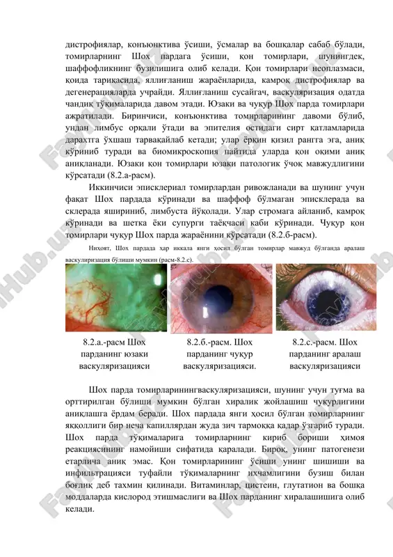 usaygach, vaskulyarizatsiya odatda chandiq to'qimalarida davom etadi. yuzaki va chuqur shox parda tomirlari ajratiladi. birinchisi, kon'yunktiva tomirlarining davomi bo'lib, undan limbus orqali o'tadi va epiteliya ostidagi sirt qatlamlarida daraxtga o'xshash tarvaqaylab ketadi; ular yorqin qizil rangga ega, aniq ko'rinib turadi va biomikroskopiya paytida ularda qon oqimi aniq aniqlanadi. yuzaki qon tomirlari yuzaki patologik o'choq mavjudligini ko'rsatadi (8.2.a-rasm). ikkinchisi episklerial tomirlardan rivojlanadi va shuning uchun faqat shox pardada ko'rinadi va shaffof bo'lmagan episklerada va sklerada yashirinib, limbusta yo'qoladi. ular stromaga aylanib, kamroq ko'rinadi va shetka yoki supurgi tayoqchasi kabi ko'rinadi. chuqur qon tomirlari chuqur shox parda jarayonini ko'rsatadi (8.2.b-rasm). nihoyat, shox pardada har ikkala yangi hosil bo'lgan tomirlar mavjud bo'lganda aralash vaskulirizatsiya bo'lishi mumkin (rasm-8.2.c). 8.2.a.-rasm shox pardaning yuzaki vaskulyarizatsiyasi 8.2.b.-rasm. shox pardaning chuqur vaskulyarizatsiyasi. 8.2.c.-rasm. shox pardaning aralash vaskulyarizatsiyasi shox parda tomirlariningvaskulyarizatsiyasi, shuning uchun tug'ma va orttirilgan bo'lishi mumkin bo'lgan xiralik joylashish chuqurligini aniqlashga yordam beradi. shox pardada yangi hosil …