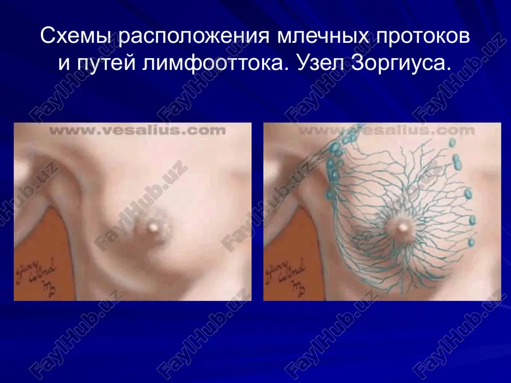 ujenii atipichnix kletok pri ekstsizionnoy biopsii, pri otyagoshennom semeynom anamneze. makropreparat pri krupoznokistoznoy forme mastopatii intraduktalnaya papilloma glavnaya prichina patologicheskix videleniy iz soska. videleniya spontannie, serozno-gemorragicheskie, odnostoronnie i, kak pravilo, iz ustya odnogo protoka. mammografiya pokazana dlya isklyucheniya drugoy patologii. lechenie: issechenie porajennogo protoka ginekomastiya reduktsionnaya mammoplastika pri gipertrofii molochnix jelez epidemiologiya raka molochnoy jelezi vedushyaya opuxol u jenshin v bolshinstve razvitix stran; v strukture zabolevaemosti v rossii zanimaet 1-e mesto; 16% vsex zlokachestvennix opuxoley v nashey strane u jenshin; v shvetsii ego udelniy ves znachitelno vishe - 25-27%, v nekotorix shtatax ssha - do 30%, a v osake (yaponiya) - 8%; zabolevaemost naseleniya rossii zlokachestvennimi novoobrazovaniyami molochnoy jelezi za poslednie 15 let uvelichilas kajdiy god v mire registriruetsya bolee 650000 novix sluchaev raka molochnoy jelezi. v stranax sng - svishe 50000; chastota raka molochnoy jelezi neuklonno rastet. v 1980 g. zabolevaemost rakom grudi sostavlyala 22,6 na 100 tis. naseleniya, …