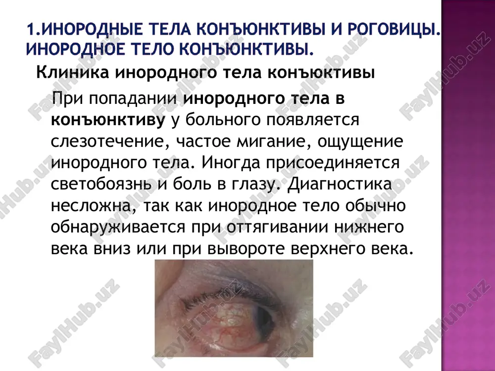 ey ee tolshine; 2. nalichie ushemleniya mejdu krayami rani rogovitsi ili skleri vnutrennix obolochek glaza (radujki, resnichnogo tela, sobstvenno sosudistoy obolochki, setchatki), libo steklovidnogo tela; 3. nalichie vnutri glaza inorodnogo tela. obrabotka koji vek proizvoditsya 1% rastvorom brilliantovogo zelenogo, dlya snyatiya bolevogo sindroma — installyatsii 0,5% rastvora dikaina. profilaktika infektsionnix oslojneniy: 30% rastvor sulfatsil-natriya ili sulfatsilovaya maz; 0,25% rastvor levomitsetina, libo levomitsetinovaya maz. pri uslovii, chto etap transportirovki bolnogo v spetsializirovannoe lechebnoe uchrejdenie mojet zanyat bolee 2—3 chasov, neobxodimo v/m vvedenie antibiotikov, a dlya preduprejdeniya vozmojnogo razvitiya stolbnyaka — vvedenie protivostolbnyachnoy sivorotki i stolbnyachnogo anatoksina. termicheskie ojogi mogut soprovojdatsya raneniem ili kontuziey glaza, vnedreniem v koju vek, kon'yunktivu, rogovitsu chastits poroxa ili metalla. bistrogo oxlajdenie glaza xolodnoy protochnoy vodoy i ustranenie povrejdayushego faktora vatnim tamponom, pintsetom, in'ektsionnoy igloy i dr pri neobxodimosti provoditsya mestnoe (dikain) i obshee (naprimer, promedol, omnopon) obezbolivanie. pri nalichii pokazaniy — borba s shokom koja vek …