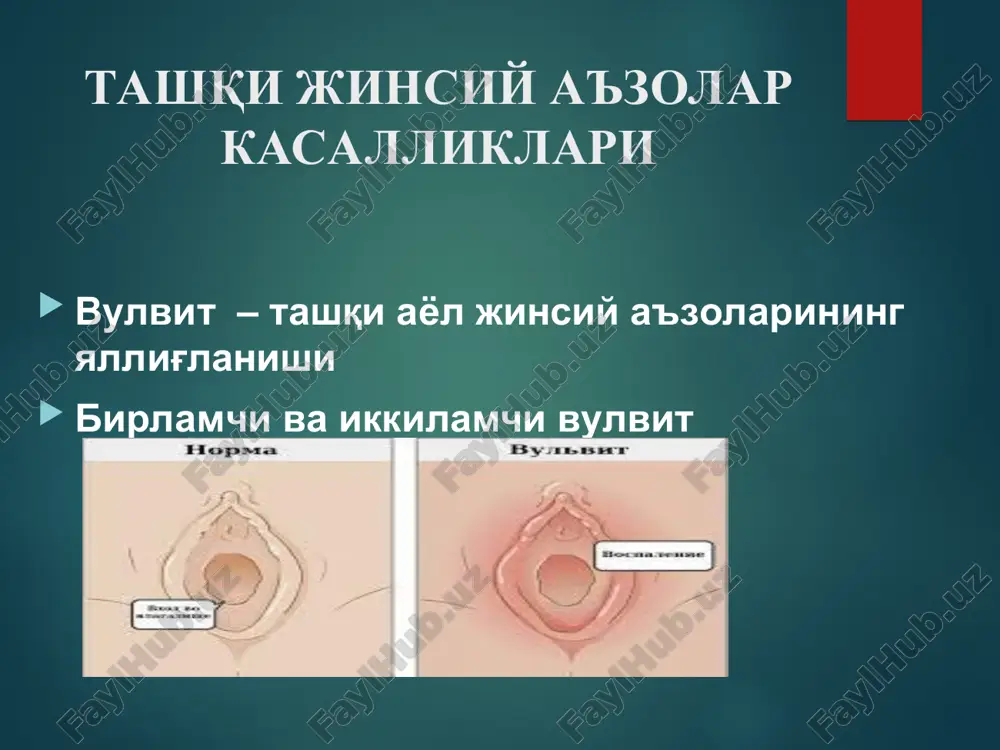 ichishish,achishish dispareuniya dizuriya surunkali shaklda klinik belgilar yakkol namoyon bulmasligi mumkin klinika o'tkir shaklida shilliq qavatda quyidagi o'zgarishlar bo'ladi: - shish; - giperemiya; - qo'l yoki instrument bilan tekkanda qonaydi; - yiringli yoki seroz karashma bilan qoplangan bo'ladi. diagnostika – ginekologik ko'zgularda ko'rish davo: dieta-shakarli maxsulotlar,uglevodalar, achchiq,sho'r maxsulotlar emaslik,gazli ichimliklar mumkin emas tashqi jinsiy a'zolar taxorati(romashka,shalfey tindirmalari,furatsillin,tsiteal eritmasi) 3-4 kun davomida flukanazol 150 mg x 1 maxal kunora №3ta hayzni 1 kunidan boshlab(er xotin) metostil eki geksikon 1 svx 2 max qinga 7 kun laktodji 1 kaps x3 max 1 oy trixopol 1t x 3 max 7 kun endotservitsit endotservitsit (endocerviicis) – bachadon bo'ynini shilliq qavatini yallig'lanishi turlari: o'tkir endotservitsit surunkali endotservitsit klinika: ko'p miqdorda shilliqli yoki yiringli yoki shilliqli yiringli ajralma; bel va qov soxada tortuvchi og'riq; ko'zgularda bachadon bo'yni tashqi bo'g'zida giperemiya,yiringli shilliqni ko'rishimiz mumkin diagnostika klinik belgilar ko'zgularda ko'ruv kolposkopiya ajralmani bakteriologik tekshirish tsitologik va morfologik tekshirish …