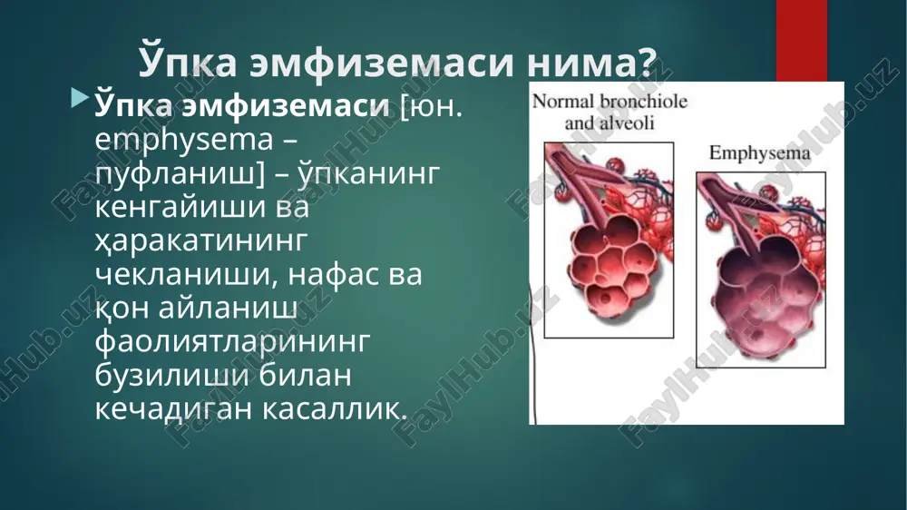 devori yupqalashadi va yirtiladi, natijada ular kengayadi. pnemoskleroz (o'pkada biriktiruvchi to'qimaning o'sib ketishi), shuningdek, tamaki chekish ham u. e. ning rivojlanishiga yordam beradi. kasallik uzoq davom etadi. bemorning nafasi qisdi, yo'taladi, dastlab jismoniy ish qilganida, keyinchalik tinch holatida ham qiynalib nafas chiqaradi. bemorning yuzi shishib, ko'krak qafasi «bochkasimon» bo'lib qoladi. kasallik asta-sekin zo'rayib boradi. bochkoobraznaya grudnaya kletka: uvelichenie perednezadnego razmera izmenenie nogtey surunkali gipoksiyada sssledstvie xronicheskoy gipoksii qaysi kasalliklar emfizemaga olib keladi: bronxial astma bronxit tuberkulyoz chekish tsentroatsinar emfizema panatsinar emfizema aralash emfizema tsentroatsinarnatstststsemfizema p panatsinarnaya emfizema bronxografiya (bokovaya proektsiya). bez patologii diagnostikasi bronxografiya bronxografiya (pryamaya proektsiya). bez patologii meshotchatie bronxoektazi normalnaya spirogramma spirogramma pri emfizeme normal spirogramma spirogramma emfizemada u. e. ni shifokor davolaydi. quruq va ilik havo sharoitida iqlim bilan davolash yaxshi naf beradi. o'pka emfizemasining oldini olish uchun bronlar va o'pkaning surunkali kasalliklarini o'z vaqtida davolash, chekmaslik zarur. 20 image6.png image7.jpeg image8.jpeg image9.jpeg image10.jpeg image11.png image12.png image13.png …