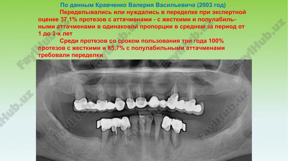 edayut jevatelnoe davlenie na slizistuyu obolochku i alveolyarnie otrostki 5 elementi kombinirovannogo s'emnogo proteza opornie konstruktsii (koronki, mostovidnie protezi) s patritsey ili matritsey, chashe s dopolnitelnimi frezerovannimi elementami (pridesnevimi i prisheechnimi ustupami, interlokami) karkas s'emnogo opirayushegosya proteza (op): duga ili tselnolitoy bazis sedla s retentsionnimi elementami i ogranichitelyami klammera, shariki dlya snyatiya op zamki (attachmeni), balki, ix sochetanie otvetnaya chast v bazise proteza frezerovannie elementi op (plecho, interlok) prochie (kipmayderi, shiniruyushie elementi, okklyuzionnie nakladki, fasetki ili litie zubi) teleskopicheskie ili dvoynie koronki 3. plastmassoviy bazis s iskusstvennimi zubami 6 viravnivayushie elementi k nim otnosyatsya prejde vsego nebnie, lingvalnie ili labialnie dugi i tselnolitie bazisi, kotorie soedinyayut sedlovidnie chasti op minimalnaya effektivnost mnogozvenevogo bazisa, kak samostoyatelnogo viravnivayushego elementa 7 viravnivayushie elementi eto komponenti op, k kotorim pryamo ili oposredovanno prisoedineni vse ostalnie chasti proteza oni doljni obespechivat perekrestno-dugovuyu stabilizatsiyu, protivodeystvuya smesheniyu, voznikayushemu vsledstvie funktsionalnix peregruzok bolshoy soedinitel mojno sravnit s shassi …