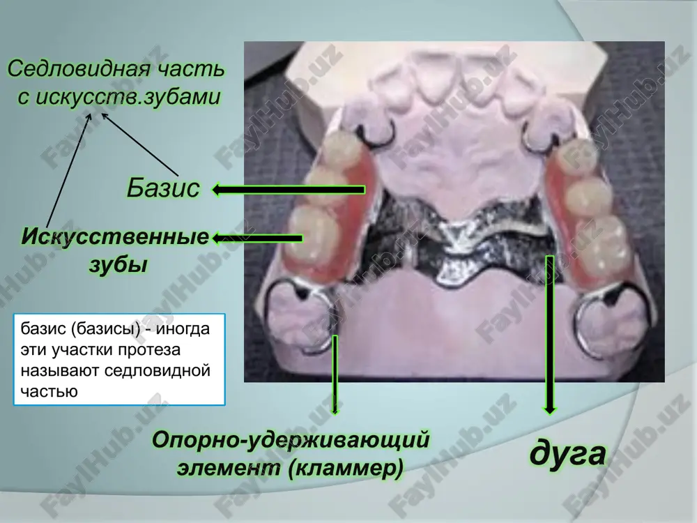 tochkoy neba 12 podkovoobraznaya duga esli nebo ploskoe, ploxo virajeni alveolyarnie otrostki i prisutstvuyut kontsevie defekti zubov – duga imeet vid tonkoy i shirokoy plastinki. takaya forma dugi sposobstvuet luchshemu pereraspredeleniyu jevatelnoy nagruzki. pokazaniya k primeneniyu podkovoobraznoy formi dugi: nalichie povishennogo rvotnogo refleksa. dlya zamesheniya zubov pri kontsevix defektax. nevozmojnost protezirovaniya perednix zubov mostovidnimi protezami. shinirovanie zubov pri ix patologicheskoy podvijnosti. sushestvuyut dve formi metallicheskoy dugi v perednix otdelax: vorotnikovaya i bezvorotnikovaya. pri vorotnikovoy forme bazis konstruktsii, kak vorotnik, prilegaet k krayu desni reztsov i klikov i mojet vizvat travmu kraevogo parodonta. takaya forma dugi protivopokazana pri nalichii nizkix klinicheskix koronok perednix zubov, i rekomenduetsya pri glubokom prikuse. pri bezvorotnikovoy forme bazis proteza ne kontaktiruet s estestvennimi zubami. koltsevaya duga koltsevaya duga — bolee jestkaya konstruktsiya. ona obrazovana dvumya uzkimi poloskami, kotorie prilegayut k zadnemu i perednemu otdelam neba. pokazaniya: otsutstvie zubov bolshoy protyajennosti. nalichie anatomicheskix prepyatstviy dlya primeneniya otdelnoy …