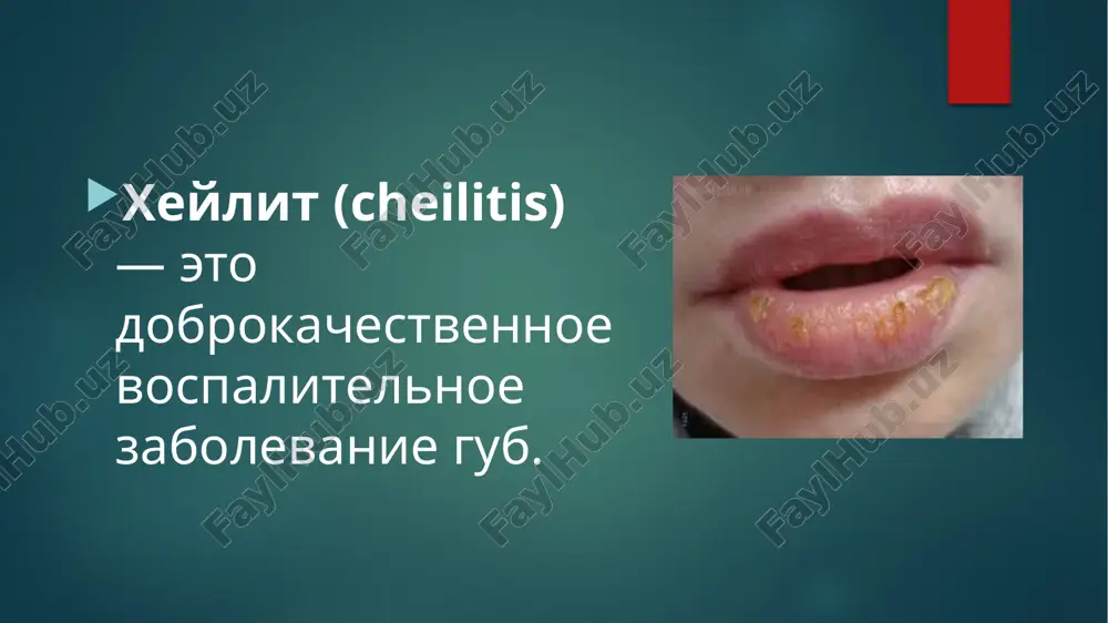yaetsya formirovaniem na poverxnosti gubi (ot ugla do ugla) korochek serovatojeltogo ili jelto-korichnevogo tsveta. porajyonnaya slizistaya obolochka v zone kleyna otyochna, giperemirovana, boleznenna. posle udaleniya korok otkrivaetsya yarko giperemirovannaya poverxnost gubi bez eroziy. sub'ektivno: patsienti otmechayut boleznennost gub, chuvstvo jjeniya, skleivanie gub. suxaya forma zabolevaniya xarakterizuetsya obrazovaniem serovatix i jeltovatix cheshuek, prikreplennix svoim tsentrom k krasnoy kayme gub. legko snimayushiesya cheshuyki obnajayut zastoyno-krasnuyu poverxnost gubi bez eroziy. sub'ektivno: bolnie otmechayut suxost gub, jelanie postoyanno skusivat cheshuyki. gistologicheski pri eksfoliativnom xeylite viyavlyayut akantoz, para- i giperkeratoz; razrixlenie epitelialnogo sloya i obrazovanie v nyom obshirnix sheley vsledstvie vnutrikletochnogo lizisa. diagnostika osnovana na: klinicheskix dannix; lokalizatsii na krasnoy kayme gubi strogo v xarakternix granitsax; pod cheshuyko-korkami ne viyavlyaetsya povrejdeniy epiteliya krasnoy kaymi gubi. differentsialniy diagnoz. suxuyu formu sleduet otlichat: –ot meteorologicheskogo xeylita, pri kotorom porajaetsya vsya poverxnost krasnoy kaymi gubi i proslejivaetsya svyaz s deystviem meteorologicheskix faktorov; –atopicheskogo xeylita (porajaetsya chast krasnoy kaymi …
