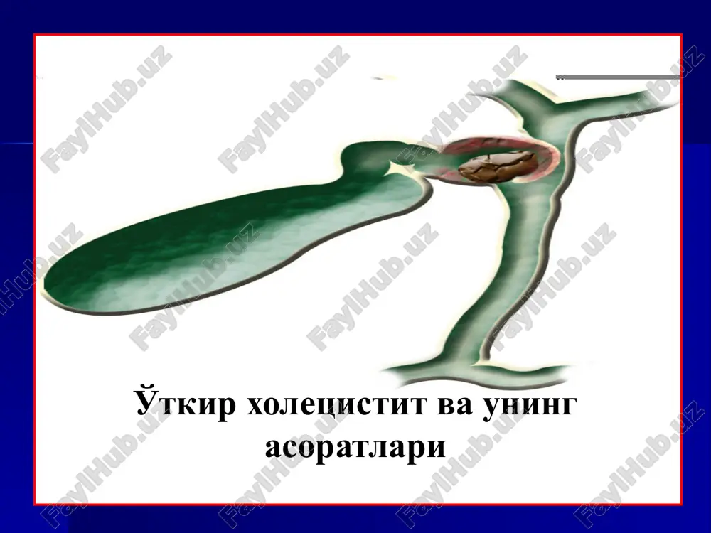 g'ich stenozi, pankreatit) o't yo'llari gipertenziyasi (toshlar, tashqi blok) infektsiya o't qopi arteriyasining trombozi jarohatlar ikkilamchi yallig'lanish o'tkir xoletsistit etiopatogenezi o'tkir xoletsistitning klinik manzarasi sub'ektiv belgilar: o'ng qovurg'a ravog'i ostida og'riq og'riq irradiatsiyasi ko'ngil aynishi og'izda achchiq ta'm va qurishi jig'ildon qaynashi qayt qilish og'riqning ovqat bilan bog'liq ligi qorinning dam bo'lishi ob'ektiv belgilar kattalashgan o't qopi qorin devori tarangligi simptomlar: merfi, myussi, grekov-ortner, reflektor stenokardiya temperatura ortishi leykotsitoz echt ning ortishi diagnostikasi noinvaziv ultratovushli tekshiruv rentgenografiya kompyuter tomografiya magnit-rezonans tomografiya invaziv usullar ante- i retrograd xolangiografiya laparoskopiya qalinlashgan devor va paravezikulyar yiring o't qopi bo'yinchasidagi tosh o'tkir xoletsistitda utt manzarasi asoratlangan o'tkir xoletsistit utt paravezikulyar abstsess paravezikulyar infiltrat kompyuter tomografiya konkrementlar o't qopi o'tkir gangrenoz xoletsistit o'tkir xoletsistit laparoskopik ko'rinishi endoskopik retrograd xolangiopankreatikografiya (erpxg) antegrad xolangiografiya (tjoxg) o'tkir xoletsistit asoratlari perforatsiya va o'tli peritonit, yiringli xolangit, sindrom mirizzi, biliodigestivnie oqma, xoledoxolitiaz, mexanik sariqliq, o'tkir pankreatit, jigar etishmovchiligi xoledoxolitiaz. mexanik …
