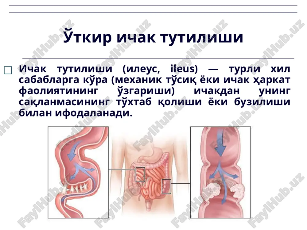 hak medikamentoz stimulyatsiyasi, og'ir jismoniy yuklamadan so'ng qorin ichki bosimining ortib ketishi va enterokolit rivojlanishi. etiologiya ‹#› patogenez o'it patogenezi asosiy nazariyasi: intoksikatsion; bioximik; gemodinamik; nerv-reflektor. ‹#› 1. ichak devorida tsirkulyator buzilishlar; 2. ichak motor funktsiyasi buzilishlari; 3. ichak sekretor-rezorbtiv faoliyatidagi o'zga-rishlar: filtratsiya jarayonlarining buzilishi – reabsorbtsiya; 4. endogen intoksikatsiya va metabolizmning barcha bo'g'inlarda buzilishi. umuman, ichak pasaji buzilishidagi organizmdagi patologik o'zgarishlar mexanizmi keng qirrali bo'lib funktsional ichak etishmovchiligi deb ataladi. patogenez ‹#› klinik manzarasi og'riq sindromi (hurujsimon, to'lg'oqsimon, aniq joyiga ega bo'lmagan); dispepsik sindrom (ich kelmasligi, gaz ajralmasligi, qayt qilish, qorin dam bo'lishi, chanqash, og'iz qurishi); yallig'lanish va peritoneal sindromlar; ‹#› val simptomi – ko'zga tashlanuvchan va qo'lga seziluvchan ko'chib yurmaydigan, asimmetrik, nisbatan turg'un bo'lgan qorin shishi; val sindromi boshqa belgilari bilan namoyon bo'lib: − ko'zga ko'rinuvchi peristaltika; − qorin asimmetriyasi; − palpatsiyalanuvchi o'smasimon xosila; − xosila ustida timpanik tovush eshitilishi. ichak tutilishi simptomlari: ‹#› mate–sklyarov simptomi — qorin …