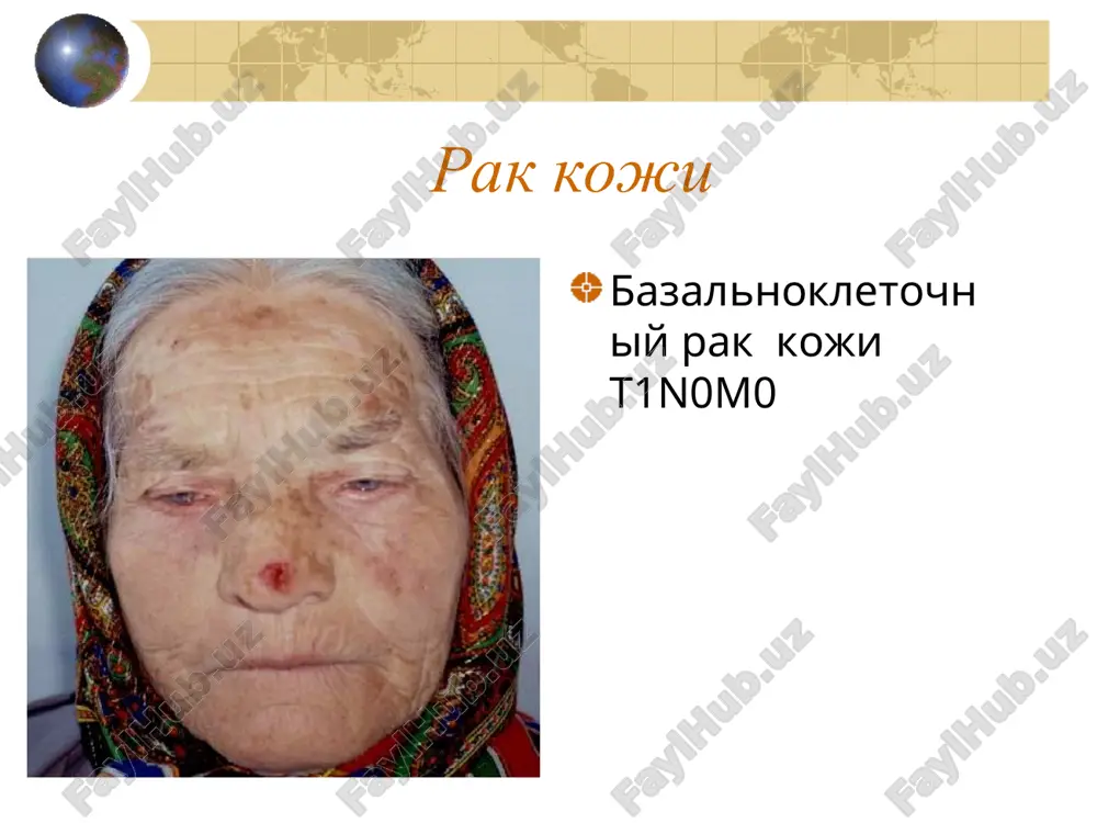 anomi melanotsit  nevus  displastichniy nevus  melanoma “in situ”  poverxnostnaya melanoma  uzlovaya melanoma  metastaticheskaya melanoma klinicheskie formi rosta melanomi: poverxnostnaya (gorizontalniy) - 70% uzlovaya melanoma - 15-20% lentigo-melanoma - 4 -10% akralnaya melanoma - 2-8% bespigmentnie melanoma - 5% melanoma: abcd - test epilyuminestsentniy mikroskop (dermatoskop) 10 epilyuminestsentnaya mikroskopiya elm fluorestsentnaya mikroskopiya melanomi koji in vivo , 10 elm elm efm efm: 1 - pigmentnaya papilloma, 2 – giperkeratoz 3 – nevus , 4 - melanoma 1 2 4 3 diagnosticheskaya kompyuterizirovannaya sistema tolshina melanomi i ee "kriticheskaya massa" t1 4 mm ø 2 mm = 0,004 sm3 = 4·106 kl. ø 4 mm = 0,033 sm3 = 33·106 kl. ø 1,25 sm = 1,0 sm3 = 1 g = 109 kl. ø 2 sm = 4,2 sm3 = 4·109 kl. ø 3 sm = 14 sm3 = 14·109 kl. ø 5 sm = 65,4 …