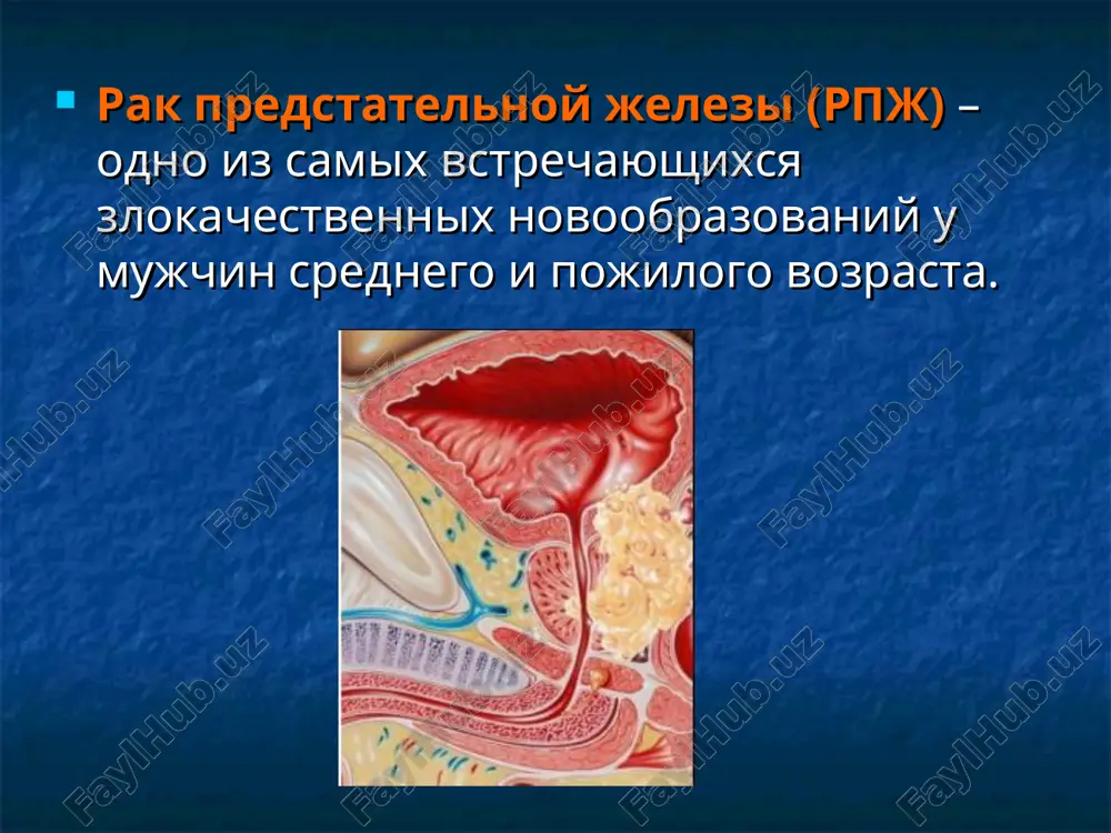 tkani - tak nazivaemaya perexodnaya zona. v norme ona prakticheski ne differentsiruetsya ot tsentralnoy zoni i zanimaet vsego 5% ob'ema prostati. v perexodnoy zone rak razvivaetsya v 20% sluchaev. perifericheskaya zona 75% - rak 80% tsentralnaya zona 20% - rak 5% perexodnaya zona 5% - rak 20% tnm klassifikatsiya tx –nedostatochno dannix dlya otsenki pervichnoy opuxoli t0- pervichnaya opuxol ne opredelyaetsya t1- opuxol klinicheski ne proyavlyaetsya, ne palpiruetsya i ne vizualiziruetsya luchevimi sposobami t1a- opuxol sluchayno obnarujivaetsya pri gistologicheskom issledovanii i sostavlyaet menee 5% rezetsirovannoy tkani t1b- opuxol sluchayno obnarujivaetsya pri gistologicheskom issledovanii i sostavlyaet bolee 5% rezetsirovannoy tkani. t1s- opuxol diagnostiruetsya s pomoshyu punktsionnoy biopsii (naprimer, proizvodimoy v svyazi s visokim urovnem psa). t2- opuxol ogranichena predstatelnoy jelezoy (opuxol, diagnostirovannaya s pomoshyu punktsionnoy biopsii v odnoy ili obeix dolyax, no nepalpiruemaya i nevizualiziruemaya, klassifitsiruetsya kak t1s. t2a- opuxol porajaet polovinu odnoy doli ili menee t2b- opuxol porajaet bolee polovini …