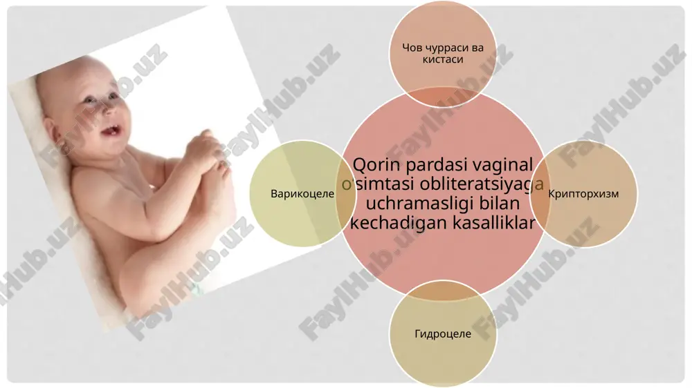 rsa sezilmaydi. chov kanalida joylashgan urug'don kamharakat bo'lib, ozgina og'rishi mumkin bo'lgan qosila tariqasida qo'lga unnaydi. 5—10 foiz bemorlarda kriptorxizm bilan birga endokrin funktsiya ham izdan chiqadi. bu ayniqsa ikki tomonlama kriptorxizmda ko'proq kuzatiladi. 25 foiz bemorlarda esa chov churrasi uchraydi kriptorxizm davosi kriptorxizm patogenezining endokrin nazariyasi tarafdorlari bu xastalikni ilk bor onservativ usul—gormonlar yordamida davolash lozim, deb aytadilar. ammo kupchilik klinitsistlar xar bir bemorga xususiy yondoshish lozimligini uktiradilar. kriptorxizmning ikki tomonlama bo'lishi, bir tomonlama bo'lgan holda ham endokrin buzilishlar bilan birgalikda uchrashi gormonal terapiya uchun ko'rsatma hisoblanadi. bunday hollarda bemorlarga gonadotropin xoriogeninni 10 yoshgacha bo'lgan bolalarga 500-1000 db (doza birligi), 10 yoshdan kattalarga esa 1500 db da, haftada ikki marta va bir oy davomida buyuriladi. budavolashdan ijobiy natija olinsa, muolaja kursi 3 oydan keyin yana takrorlanadi. arap ijobiy o'zgarish bo'lmasa, operatsiya qilish lozim. operatsiya ikki bosqichda o'tkaziladi: birinchi bosqichda urug'don pastga tushirilib, yorg'oq devorchasiga fiksatsiyalanadi. ikkinchi bosqichda son fastsiyasiga …