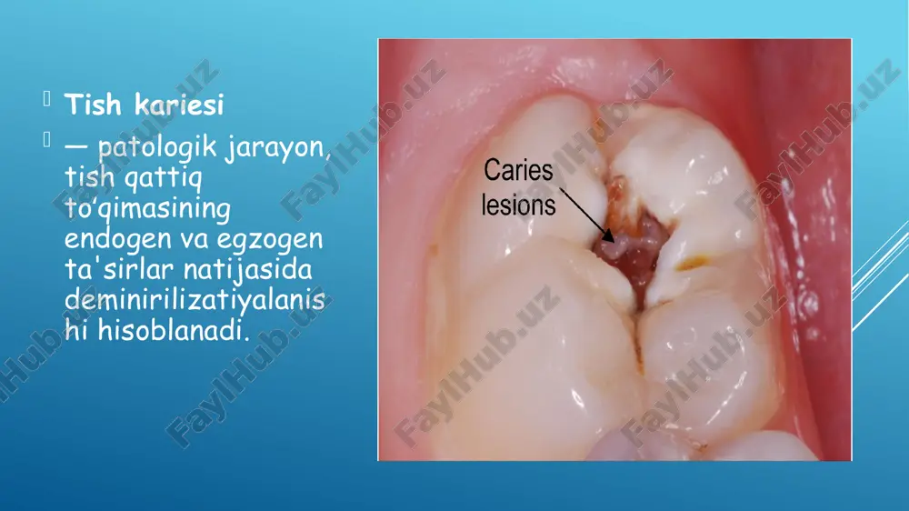 pasaytiradi va emalga salbiy ta'sir ko`rsatib, uning demineralizasiyasini yuzaga keltiradi. sharpenak nazariyasi sharpenak (1949) o`zining vitaminli nazariyasini b1 vitaminini tanqisligi bilan tushuntiradi. b1 vitaminini tanqisligida butun organizmda va ayniqsa emalda oqsillar kamayadi, natijada proteoliz kuchayadi va emal nimjon bo`lib qoladi. oqsillarni biosintezini sekinlashishi ovqatlar tarkibiga kiruvchi noyob aminokislotalarni kamayishi yoki umuman bo`lmasligi bilan bog’liq. sharpenakni taxminiga ko`ra, organizm ko`p miqdorda uglevodlarni hazm qilsa, b1 vitaminiga muxtojlik oshadi. demak b1 vitamini tanqisligida to`qimalarda pirouzum kislotasi yig’iladi va proteolizni yana ham kuchaytiradi. lekin bu nazariyaning isboti bo`lmagan. undan tashqari sharpenak emaldaga oq dog’ bosqichida demineralizasiya jarayonini inkor qilgan va mikroorganizmlar va ularni mahsulotlarnni dastlab kariesni rivojlanishida ishtiroki yo`q, deb ham xatolikka yo`l qo`ygan. ma'lumki, karies mikroorganizmlarsiz rivojlanmaydi (orlanceet.al., 1955). entin nazariyasi . tish ikki muhit (soʻlak va qon tomirlar) orasida joylashadi va shu ikki muhit orasida osmotik toklar paydo boʻladi. bu toklar emaldan pulpa tomon harakatlanadi va kariesga sabab boʻladi. natijada emalda …