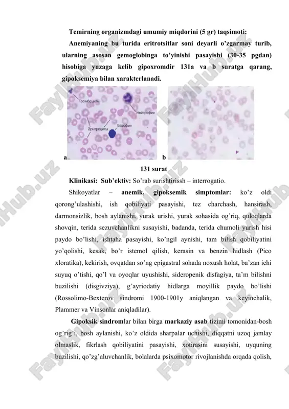 may turib, ularning asosan gemoglobinga to’yinishi pasayishi (30-35 pgdan) hisobiga yuzaga kelib gipoxromdir 131a va b suratga qarang, gipoksemiya bilan xarakterlanadi. a b 131 surat klinikasi: sub’ektiv: so’rab surishtirissh – interrogatio. shikoyatlar – anemik, gipoksemik simptomlar: ko’z oldi qorong’ulashishi, ish qobiliyati pasayishi, tez charchash, hansirash, darmonsizlik, bosh aylanishi, yurak urishi, yurak sohasida og’riq, quloqlarda shovqin, terida sezuvchanlikni susayishi, badanda, terida chumoli yurish hisi paydo bo’lishi, ishtaha pasayishi, ko’ngil aynishi, tam bilish qobiliyatini yo’qolishi, kesak, bo’r istemol qilish, kerasin va benzin hidlash (pico xloratika), kekirish, ovqatdan so’ng epigastral sohada noxush holat, ba’zan ichi suyuq o’tishi, qo’l va oyoqlar uyushishi, sideropenik disfagiya, ta’m bilishni buzilishi (disgivziya), g’ayriodatiy hidlarga moyillik paydo bo’lishi (rossolimo-bexterov sindromi 1900-1901y aniqlangan va keyinchalik, plammer va vinsonlar aniqladilar). gipoksik sindromlar bilan birga markaziy asab tizimi tomonidan-bosh og’rig’i, bosh aylanishi, ko’z oldida sharpalar uchishi, diqqatni uzoq jamlay olmaslik, fikrlash qobiliyatini pasayishi, xotirasini susayishi, uyquning buzilishi, qo’zg’aluvchanlik, bolalarda psixomotor rivojlanishda orqada …