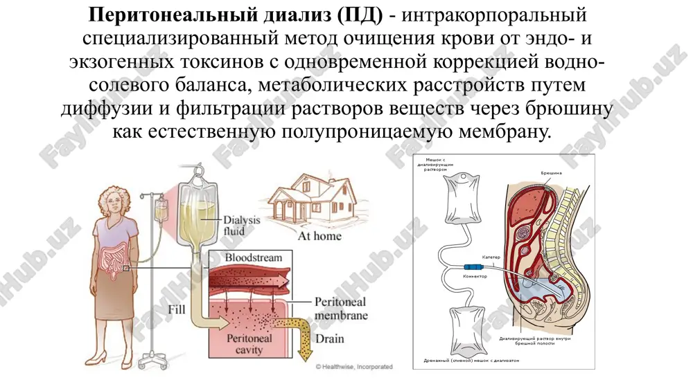 astvor glyukozi, kotoriy po kontsentratsionnomu gradientu prityagivaet jidkost. v rezultate lishnyaya jidkost iz krovotoka cherez sosudi bryushini popadaet v dializiruyushiy rastvor. postoyanniy ambulatorniy peritonealniy dializ (papd) — naibolee rasprostranenniy tip peritonealnogo dializa. dializat vvodyat v bryushnuyu polost cherez trubku, kotoraya nazivaetsya kateter. on ostaetsya tam v techenie 3-6 chasov, posle chego slivaetsya. jivot napolnyaetsya novim rastvorom. takim obrazom, krov vsegda ochishaetsya. postoyanniy tsiklicheskiy peritonealniy dializ (ptspd) — vlivanie i povtornoe zapolnenie bryushnoy polosti dializatom vipolnyaetsya s pomoshyu spetsialnogo apparata. provoditsya nochyu, vo vremya sna. prerivistiy peritonealniy dializ (ppd) — ispolzuetsya tot je apparat, chto i pri ptspd. on, kak pravilo, provoditsya v bolnitse i chasto zanimaet bolshe vremeni, chem ptspd. tip dlitelnost chastota protseduri papd 3-6 chasov, plyus 30 minut dlya sliva jidkosti 4 raza v sutki papd 9-12 chasov kajduyu noch ppd 12 chasov i bolee 36-42 chasov v nedelyu peritonealniy dializ intermitiruyushiy protsess zalivki dializata i ego udalenie …