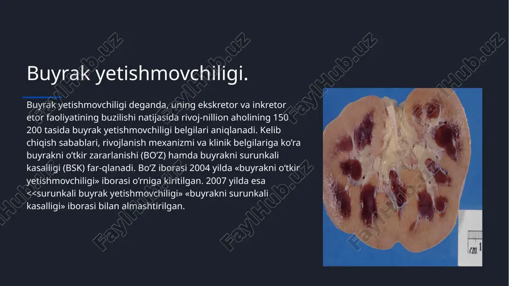 1)boshlangʻich davr- bu davrda asosan etiologik omillarga shok,gemoliz,zaharlanish kabilarga xos belgilar namoyon boʻladi. bu davr 3-4 kun davom etadi. 2)oligourik davr- bu davrda tez yoki sekin diurez kamayib,anuriya darajasigacha borishi bilan xarakterlanadi.gipergidratatsiya havo yetishmaslik hissi hamda suyuq ko’pikli yo’tal kabi klinik belgilar ko’rinishidagi o’pka shishi bilan nam-oyon bo’lishi mumkin. ba’zan kuchli rivojlangan atsidoz sababli shovqinli kussmaul nafas paydo bo’ladi. ushbu davr 1-2 hafta davom etadi. buyraklarning oʻtkir zararlanishi klinikasi. 3)poliurik davr- kunlik ajraladigan siydik miqdori 2-5 litr, ba’zan esa undan ham ko’p bo’ladi. bu davrda bemor organizmida elektrolitlar muvozanati buzilish ehtimoli yuqoriligi sababli, har kuni qonda ularni aniqlab turish lozim. bu davr 1-2 hafta davom etadi. 4)buyrak faoliyatini toʻliq tiklanishi davri- so’nggi tiklanish davri 6-12 oy davom etib, kanalchalar regeneratsiyasi kuzatiladi. laborator-instrumental tekshiruvlar. umumiy siydik tahlili:umumiy tahlilida nisbiy zichligi prerenal bo’z 1,018 dan yuqori, renalda esa 1,012 dan past bo’ladi.proteinuriya, gematuriya va kanalchalar nekrozini tasdiqlovchi donador silindrlar aniqlanadi.siydikda leykotsitlar mavjudligi …