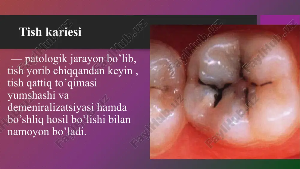 yuzasida pillukula hosil bo’lishi; og’iz suyuqligining yetarli miqdori va uning tarkibi; so’lak tarkibidagi aktiv minerallar va kimyoviy muhit; yaxshi chaynov yukidan tish yuzasidan o’zini-o’zi tozalashi; tish karashlari va blyashka xossasi; og’iz bo’shlig’ni to’g’ri gegiyenasi; ovqat xossasiga; og’iz bo’shlig’ning spetsefik va nospetsefik faktorlari; xomila rivojlanishida tish kurtagini to’g’ri shakllanishi; tishlar yorib chiqqandan keyin emalni o’z vaqtida va to’liq yetilishi; kariesga moyillik – bu tish qattiq to’qimasini karies bilan zararlanishga moyilligi. tishlarni kariesga moyilligini ta’minlaydi: tish yorib chiqqandan keyin emalni noto’liq yetilishi; noto’g’ri parxez, uglevod ko’p, lekin makro va mikro elementlar, oqsil miqdori yetishmasligi; suvda ftor miqdori normadan kamligi; tish yuzasida pellikulani yo’qligi; og’iz suyuqligini tarkibini , uning konsentratsiyasi,yopishqoqligi, hosil bo’lish tezligi va miqdorini buzilishi; emalni noto’liq kimyoviy tarkibi, ko’proq krisstallararo bo’shliqda kuzatilishi; tish pulpasini holati; tish to’qimasining yetilish va shakllanish davrida organizmning funksional holatiga; umumiy somatik kasallikdan keyin tish rivijlanishini buzilishi; kariesogen bakteriyalar karies chaqiruvchi bakteriya str. mutans kaloniyasi mikroorganizmlar saqlanadi …