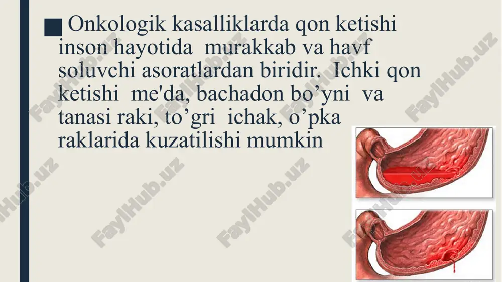 ndan so’ng, jismonij zo’riqish,stress, kichik yuklamalardan so’ng) yuzaga kelishi mumkin. bunda qindan ajralma ajralishi « majushchiy » harakterda bo’lishi uzoq periodga chuzilishi kuzatiladi. agar qon ketish jarayoni xavfli o’sma jarayoni bilan bogliq bulsa, zudlik bilan gospitalizatsiya jarayoni amalga oshiriladi.kejingi davo taktikasini belgilash maqsadida albatta gistologik va morfologik verifikatsiya uchun biopsiya amaliyoti o’tkazilishi shart.qon ketishini to’htatishda asosiy davo xirurgik aralashuvligicha qoladi, lekin, agar kasallik 4- bosqichida bo’lsa, kasallik tarqalganligi tufayli, a'zoni olib tashlash, ya'ni radikal operatsiya o’tkazish imkoniyati bo’lmaydi. o’sma hujayralarining o’sish progessiyasi va havfli o’sma hajmi kattalashib borgani sari, qon ketishi doimiy tendentsiyaga aylanib boradi, o’sma hujayralarining bo’linishi va o’sma o’sib borishi jarayonida qon tomirlar devori yemirib kuchli, spontan xarakterda bachadon ichi qon quyilishi kuzatiladi. agar qon ketish jarayoni havfli o’sma jarayoni bilan bog’liq bo’lsa, zudlik bilan gospitalizatsiya jarayoni amalga oshiriladi. keyingi davo taktikasini belgilash maqsadida albatta gistologik va morfologik verifikatsiya uchun biopsiya amaliyoti o’tkazilishi shart. qon ketishini to’xhtatishda asosiy …