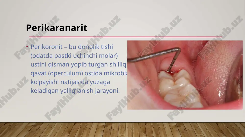 stida, ogʻiz ochishda kuchayadi limfadenit limfa tuguni kattalashishi asosiy belgidir perikoronitda limfadenit ikkilamchi alomat sifatida uchraydi asoratlari jag’ va bo’yin flegmonasi. osteomiyelit. abssesslar. sepsis. davolash maqsad: og’riqni kamaytirish yallig’lanish va infektsiyani bartaraf etish asoratlarning oldini olish donolik tishi taqdirini (saqlash yoki olib tashlash) hal qilish 1. mahalliy davolash 2. jarrohlik davolash 3. umumiy davo 4. fizioterapiya 5. profilaktika davolash turlari 1. mahalliy davolash og’iz bo’shlig’i antiseptiklari: xlorheksidin eritmasi (0,05-0,12%) furatsillin eritmasi romashka yoki salviya (shifobaxsh o’tlar) damlamasi bilan chayish yallig’langan kapyushon ostini antiseptik bilan yuvish (shpris yordamida). kapyushon ostidan yiring va oziq qoldiqlarini olib tashlash. 2. jarrohlik davolash perikoronitda koʻpincha jarrohlik aralashuv zarur boʻladi: operkulektomiya – kapyushonni (shilliq qavatni) jarrohlik yo’li bilan kesib tashlash. donolik tishini ekstraksiya qilish – agar: tish noto’g’ri joylashgan bo’lsa, o’sishiga joy boʻlmasa, qaytalanadigan perikoronitlar kuzatilsa. 3. fizioterapiya (og’ir o’tkir bosqich o’tgach qo’llaniladi): uhf terapiya laser terapiya kvarts nurlanishi xulosa 8-tish perikoronit – donolik tishi chiqishidagi …