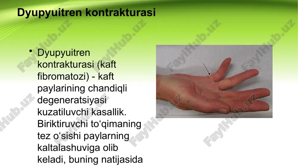 tmalari keladi. paylarning qisqarishi: barmoqlar bukilib qoladi va yozish qiyinlashadi. terining zichlashishi: tugun atrofidagi teri zichlashib, to‘qimalar bilan qo‘shilib ketadi. tortmalar va qavariqliklar: tugun sohasida tortmalar va qavariqliklar hosil bo‘ladi. og‘riq: bemorlarning taxminan 10% yelka yoki bilakda og‘riq sezadi; qolganlarida og‘riq yo‘q. diagnostikasi dyupyuitren kontrakturasining og‘irlik darajasini aniq baholash uchun shifokor: qo‘lni ko‘zdan kechiradi: teri osti tugunining joylashuvi va hajmini baholaydi. tarixni aniqlaydi: tugun va tortqilar qachon paydo bo‘lganligini aniqlaydi. harakatlar amplitudasini baholaydi: barmoqlar va bo‘g‘imlardagi harakatlarning chegaralanishini tekshiradi. laboratoriya tahlillari va qo‘shimcha instrumental tadqiqotlar odatda tashxis qo‘yish uchun talab qilinmaydi. davolash dyupyuitren kontrakturasini davolash uchun kasallikning bosqichiga qarab konservativ va jarrohlik usullari qo‘llaniladi. konservativ davolash: fiziologik muolajalar: tiklanishni tezlashtiradi. mashqlar: paylarni cho‘zish. yechiladigan langetlar: barmoqlarni yozilib ushlab turiladi. davolash blokadasi: gormonlar ("kenalog," "diprospan," "gidrokortizon") inyeksiyalari og‘riqni kamaytiradi, lekin kasallikni to‘liq bartaraf etmaydi. jarrohlik davolash: ko‘rsatma: odatda barmoqni 30° dan ortiq bukishda o‘tkaziladi. muolaja: mahalliy yoki umumiy og‘riqsizlantirish ostida chandiqli …