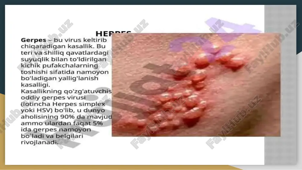 n: xotira va aqlning buzilishi, depressiya. hsv 8-turi. faqat pcr testi orqali tashxis qo'yish mumkin. virusning bu turi faqat prostata bezi va siydik-tanosil tizimi to`qimalarida topiladi. sabablar virusning yuqishi bemorning biosuyuqliklari orqali sodir bo'ladi. bundan tashqari, terining shikastlangan qismiga tegish orqali yuqtirish mumkin. xavf omillari: gigiyenaga rioya qilmaslik; notanish odamlar bilan jinsiy aloqaga kirishish; tananing haddan ortiq sovqotishi yoki qizishi; oddiy gerpes virusi kasallangan odam bilan o'pishish;; jamoat joylarida hojatxonadan foydalanish; herpesning belgilari oddiy gerpes virusining namoyon bo'lishi - bu tananing turli qismlarida paydo bo'lishi mumkin bo'lgan suyuqlikli pufakchalardir. odatda, ularning paydo bo'lishidan oldin bemorda quyidagi belgilar kuzatiladi: holsizlik; terining achishishi va qichishi; titroq. rivojlanish bosqichlari: birinchi bosqich - pufakchalar keyinroq paydo bo'ladigan joyda teri biroz qichishadi. agar terining bu joyini "aciklovir" malhami bilan yog'lansa, pufakchalar paydo bo'lishini oldini olish mumkin. yallig'lanish bosqichi - suyuqlikli pufakchalar hosil bo'lib, ular asta-sekin kattalashib boradi. yaralar bosqichi - pufakchalar yorilib, ularning o'rnini og'riq …