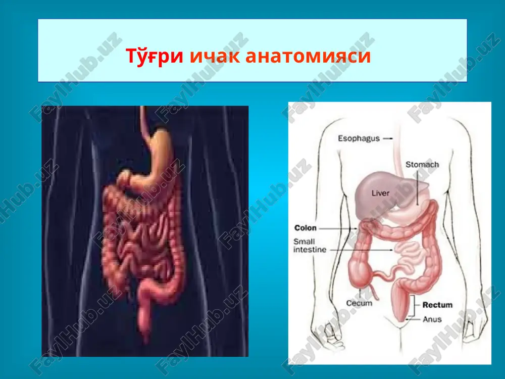 da oralikdan uzunasiga kesma orkali operatsiya 1.uzunasiga kesma orkali turgi ichak epik chuntagi ochiladi kesma liniyasi (a) va ajratilgan to'²ri ichak (b) orka chikaruv teshigi atreziyasida oralikdan uzunasiga kesma orkali operatsiya to'²ri ichak shillik kavti ochilib shillik kavat kirrasi teriga tikiladi. kundalang kesimda choklar(a) va operatsiyadan ketsingi xolat(b) orka chikaruv teshigi va to'g'ri ichak tug'ma atreziyasi xirurgik davosi orqa chiqaruv teshigi atreziyasida teri kesilib, uning shilliq qavati pastga tortilib teriga tikib qo'yiladi. to'g'ri ichak atreziyasining boshqa turlarida turli xil murakkab jarrohlik amaliyotlari qo'llaniladi. to'g'ri ichak noonkologik kasalliklari gemorroidal tugunlar orka chikaurv teshigi yorigi, pektenoz, papillyar gipertrofiya anorektal abstsess i orka chikaruv teshigi okmasi to'²ri ichak tushishi va sfinkter etishmovchiligi bavosil (gemorroy) gemorroy - to'g'ri ichak g'orsimon (kavernoz) tanachalarining venulalar orqali, arterio-venoz anastomozlarga ega bo'lgan to'g'ri ichak g'orsimon shilliq osti chigallardan qonni oqib chiqib ketishining buzilishi natijasida, ularning kengayishi bilan kechuvchi kasallik hisoblanadi. kasallik juda keng tarqalgan bo'lib, katta yoshdagi axolining …
