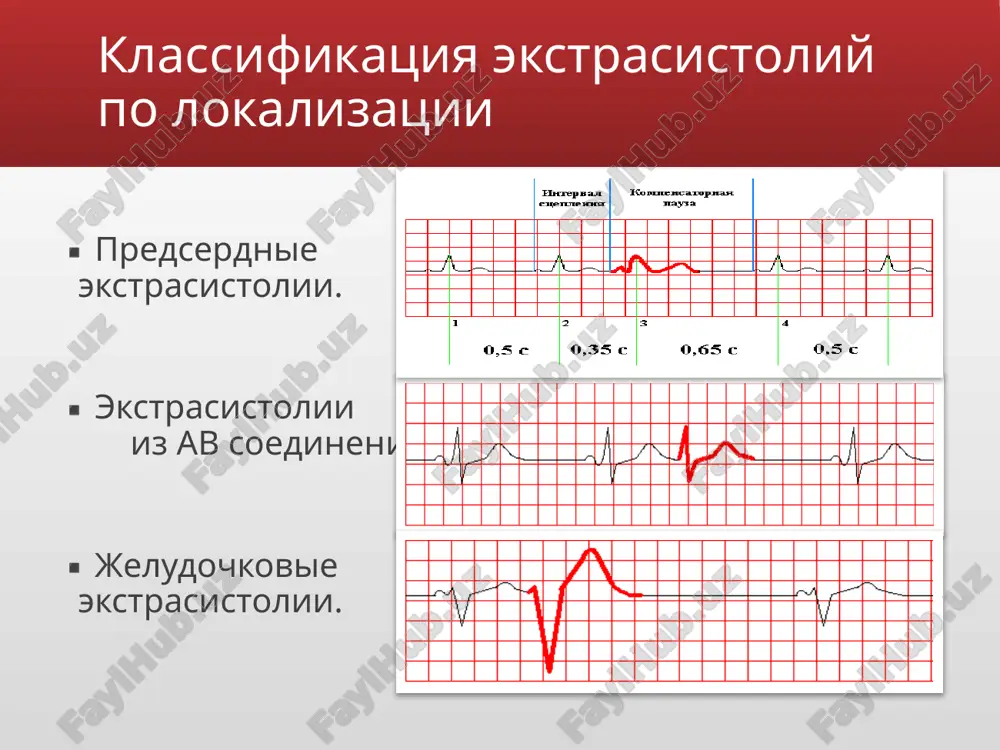 очковому комплексу, возникающему после продолжительной компенсаторной паузы, обычно имеют большую амплитуду. диагностика аускультация сердца. во время экстрасистолического сокращения выслушиваются несколько ослабленные преждевременные i и ii (или только один) экстрасистолические тоны, а после них — громкие i и ii тоны сердца, соответствующие первому постэкстрасистолическому желудочковому комплексу. диагностика инструментальные исследования для постановки диагноза экстрасистолии достаточно стандартной экг в сочетании с холтеровским мониторированием. нередко на экг или при холтеровским мониторировании экстрасистолии выявляютя случайно (при отсутствии жалоб). интервал сцепления - это расстояние от предшествующего экстрасистолы очередного цикла p–qrst основного ритма до экстросистолы. диагностика компенсаторная пауза - расстояние от экстрасистолы до следующего за ней цикла p–qrst основного ритма. различают неполную и полную компенсаторную паузу: неполная компенсаторная пауза. неполная компенсаторная пауза - это пауза, возникающая после предсердной экстрасистолы или экстрасистолы из ав-соединения, длительность которой чуть больше обычного интервала p–p (r–r) основного ритма. полная компенсаторная пауза. полная компенсаторная пауза - это пауза, возникающая после желудочковой экстрасистолы, причем …
